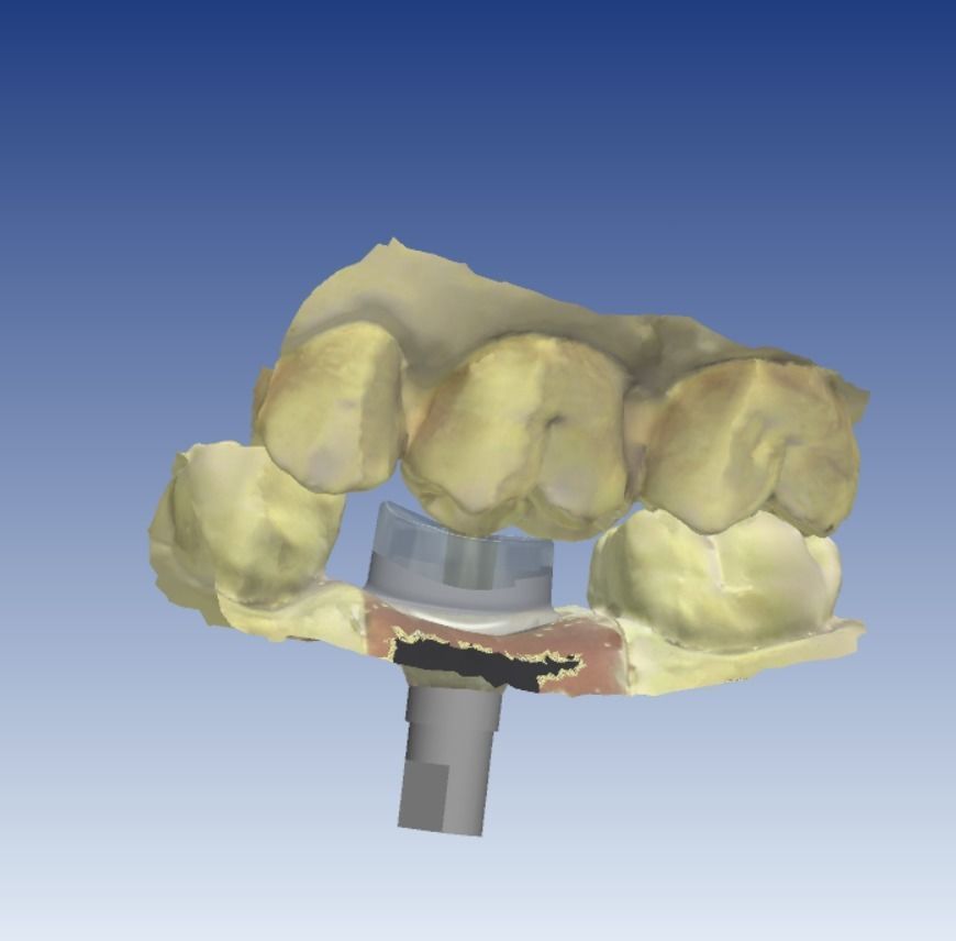 Digital Dental Implant Model with a Lab Analog 3D print model_3