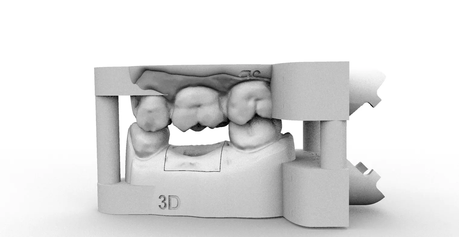 Digital Dental Implant Model with a Lab Analog 3D print model_0