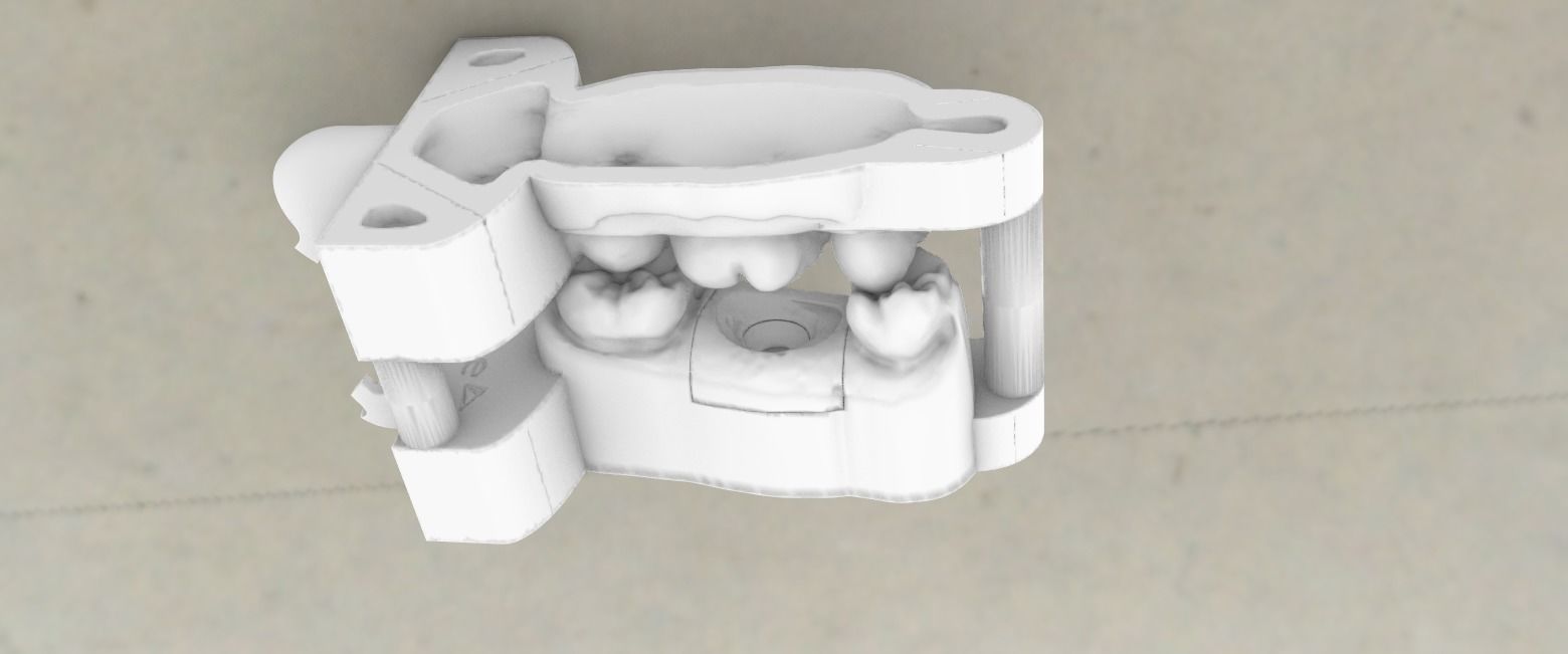 Digital Dental Implant Model with a Lab Analog 3D print model_2