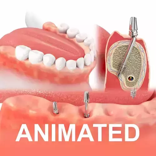 Jaws with Dental Implants Animation 3D model