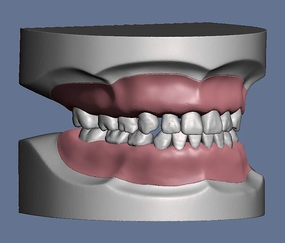 Pediatric dental model typodont type teeth with separate gum 3D print model
