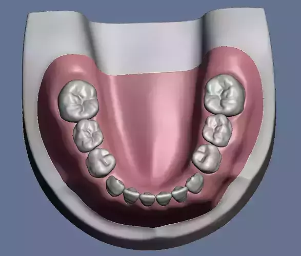 Pediatric dental model  with gum and fastening screw holes 
