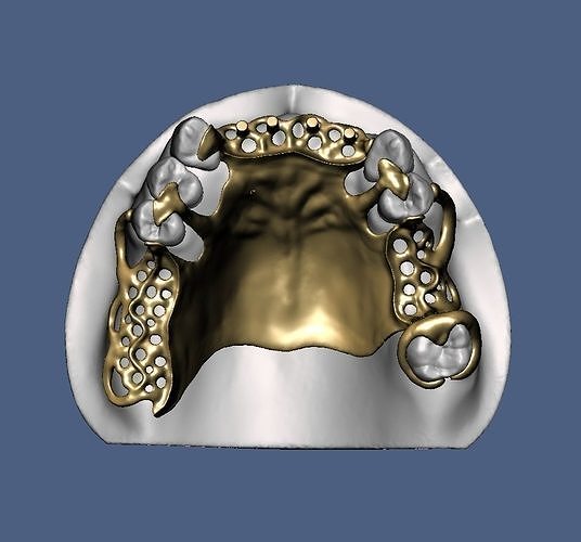 Metal framework RPD design  3D print model