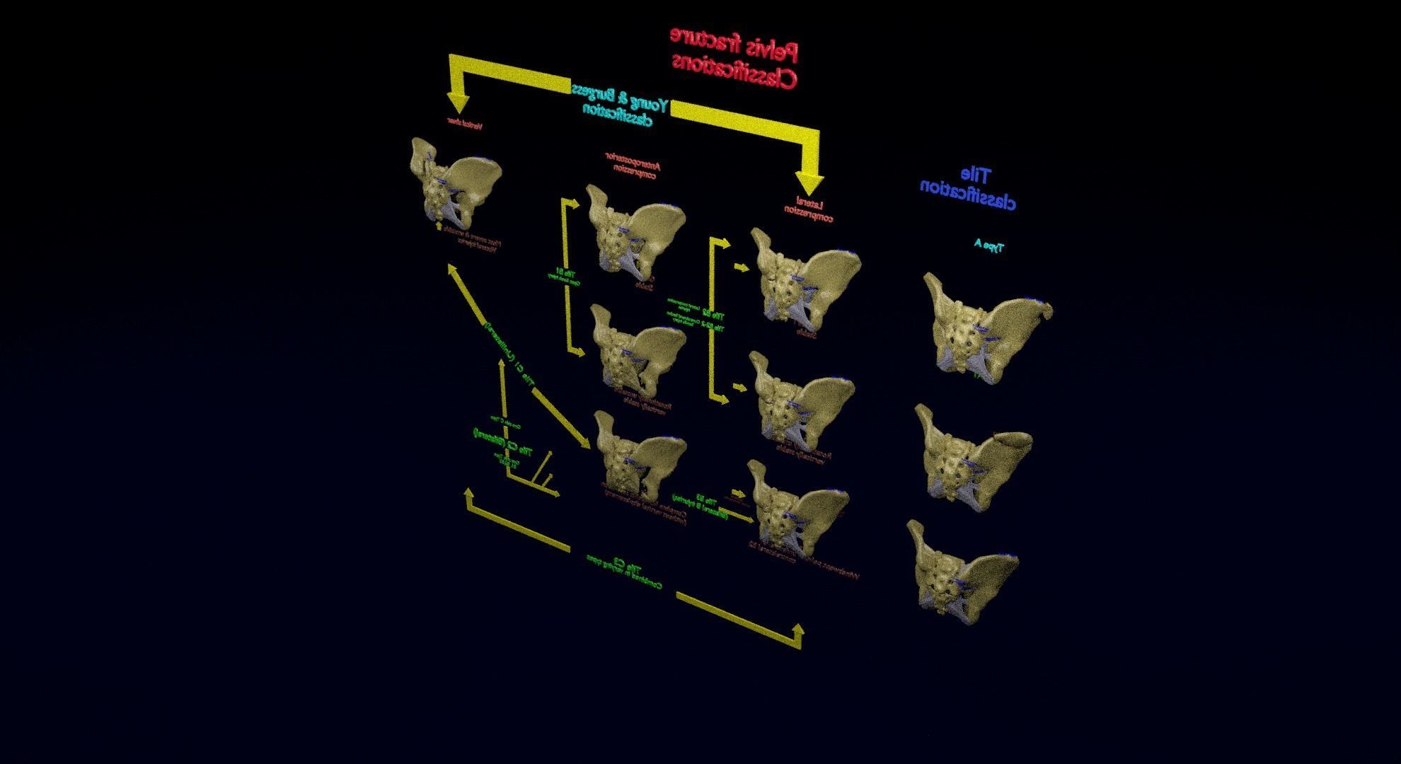 Pelvis fracture classifications 3D model_46