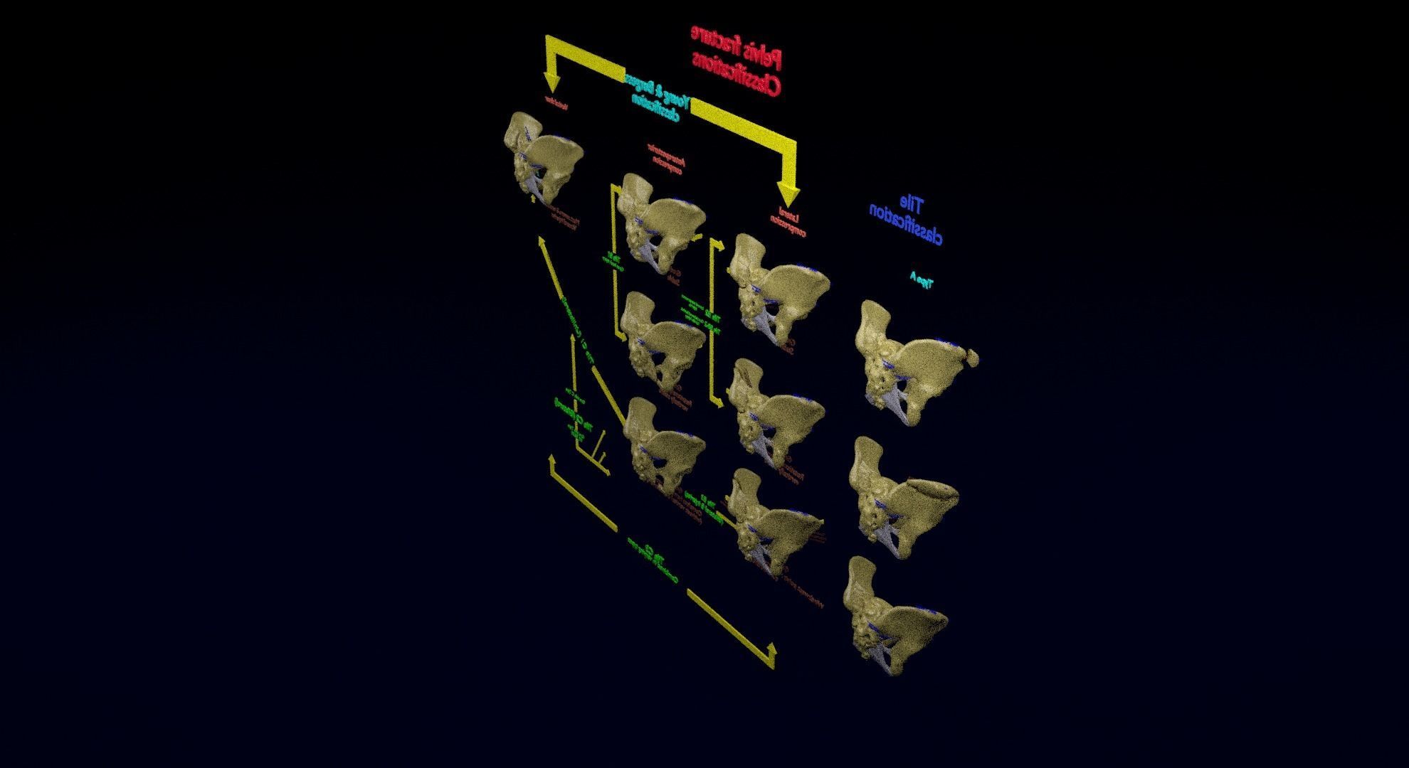 Pelvis fracture classifications 3D model_20