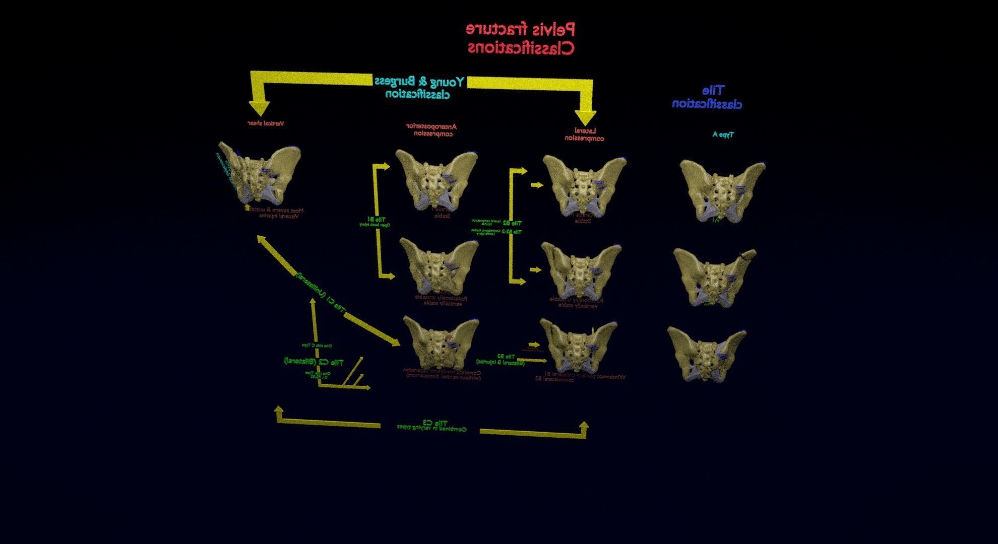 Pelvis fracture classifications 3D model_39