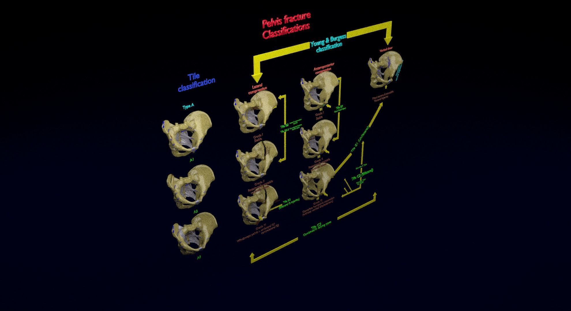 Pelvis fracture classifications 3D model_35