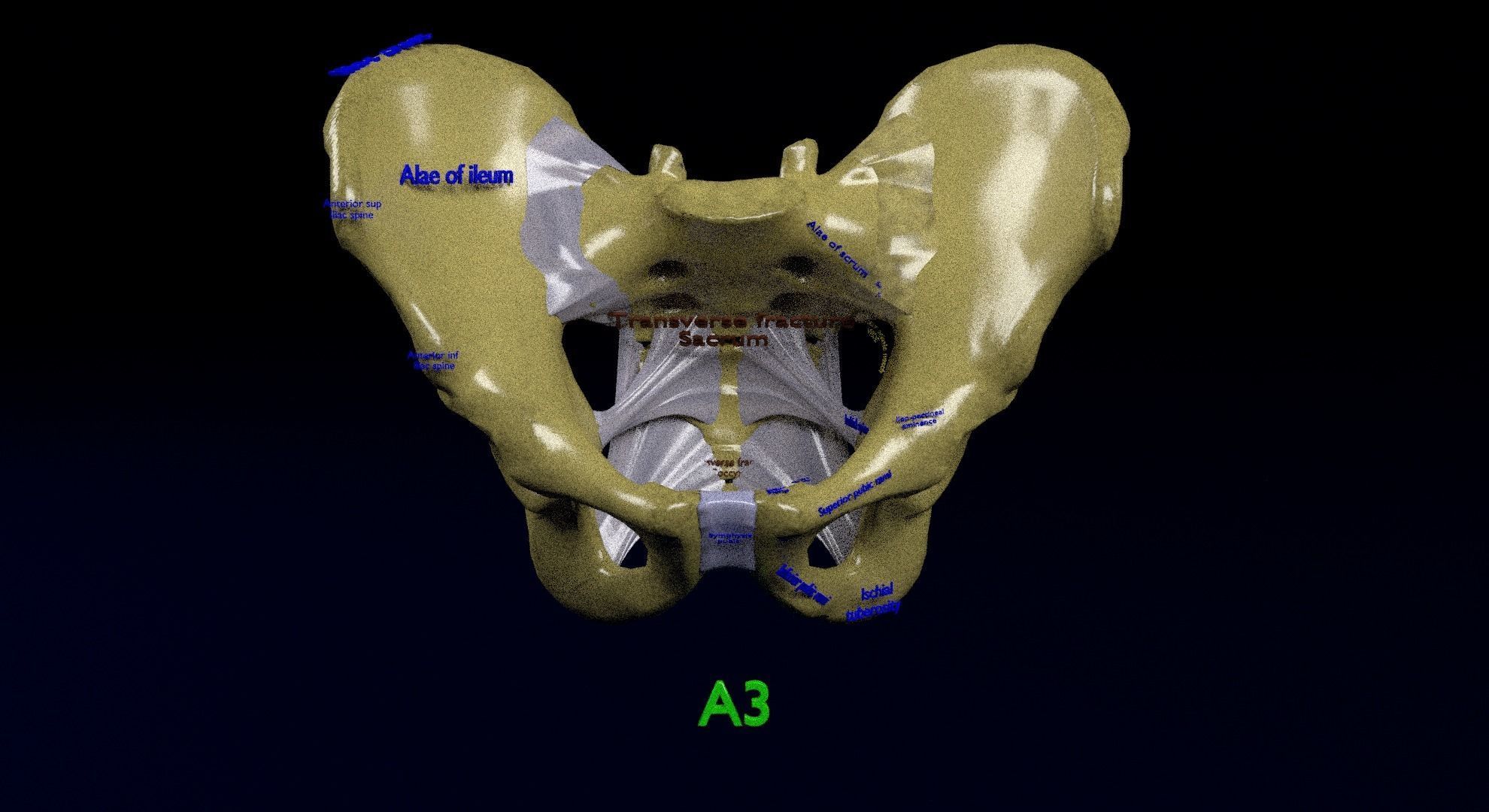 Pelvis fracture classifications 3D model_9