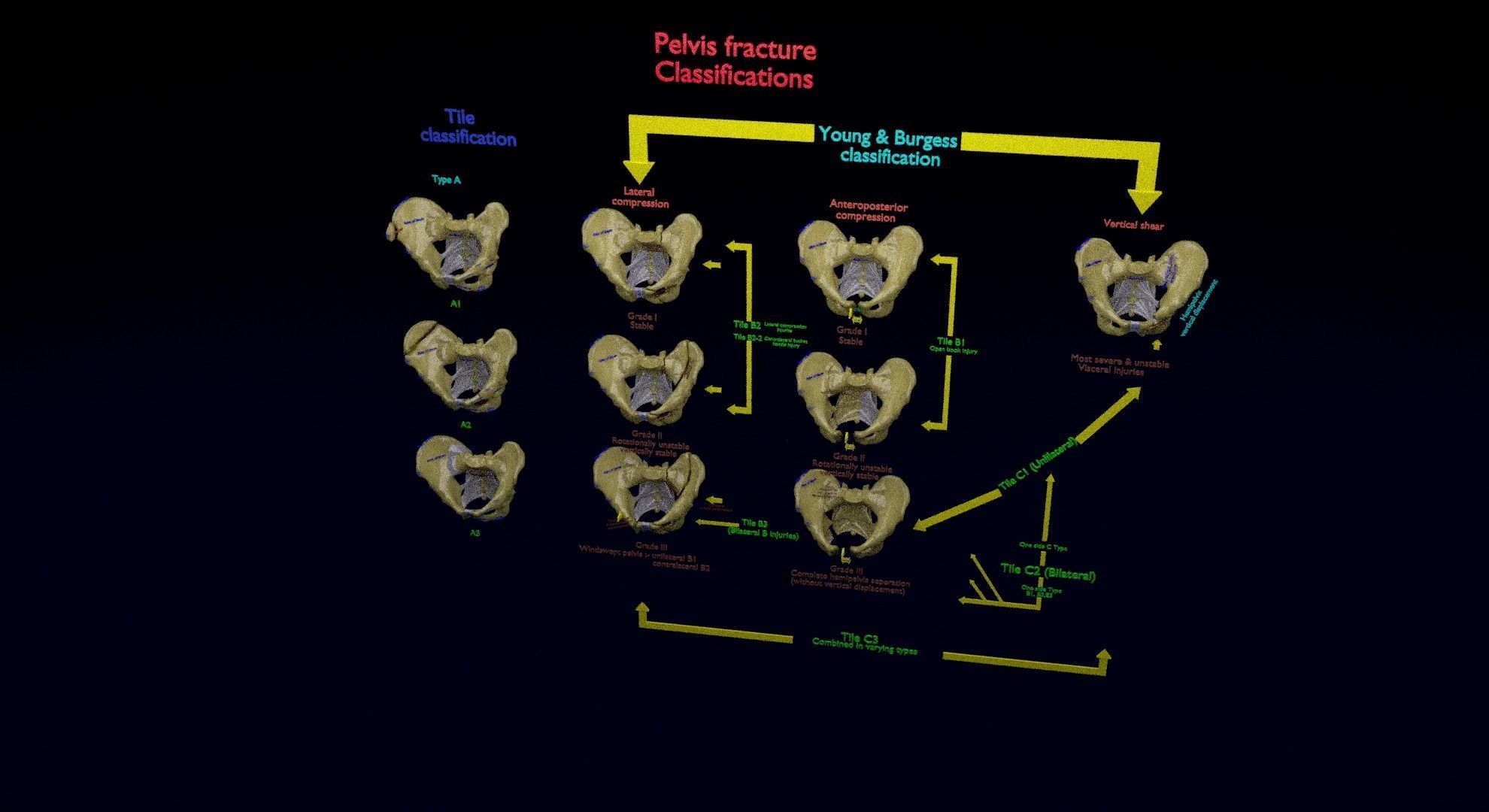 Pelvis fracture classifications 3D model_43