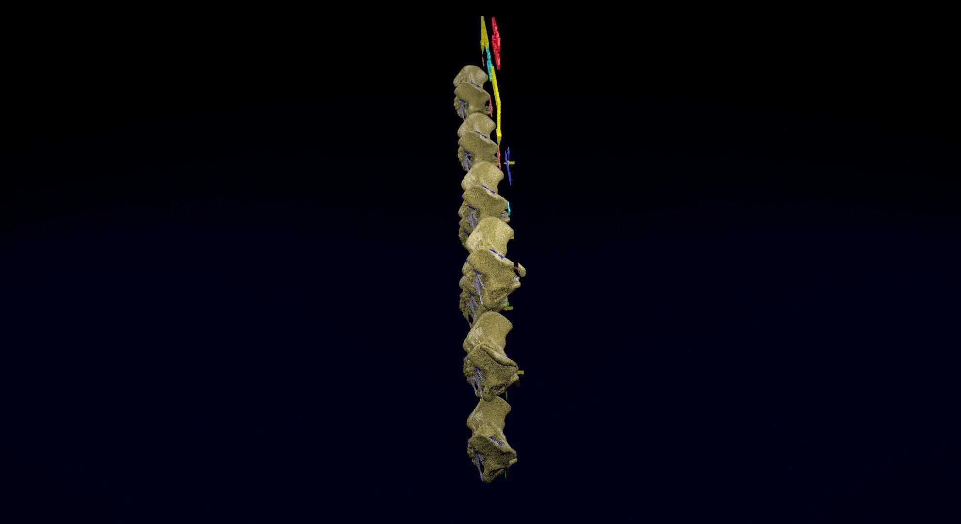 Pelvis fracture classifications 3D model_26