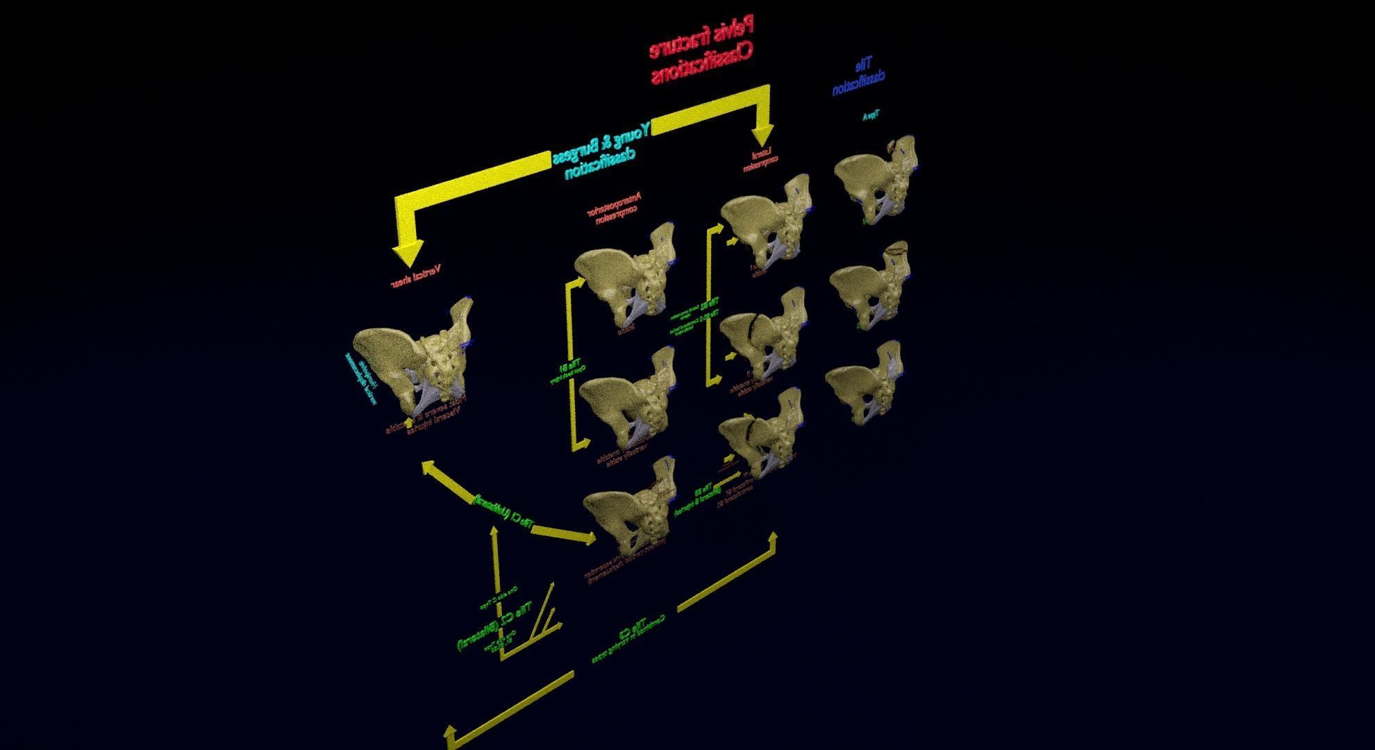 Pelvis fracture classifications 3D model_40