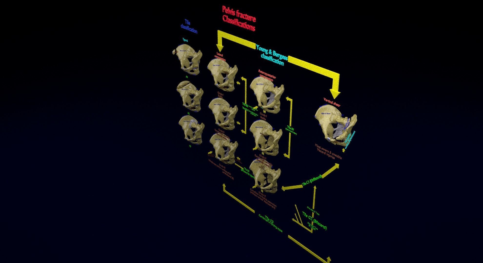 Pelvis fracture classifications 3D model_19