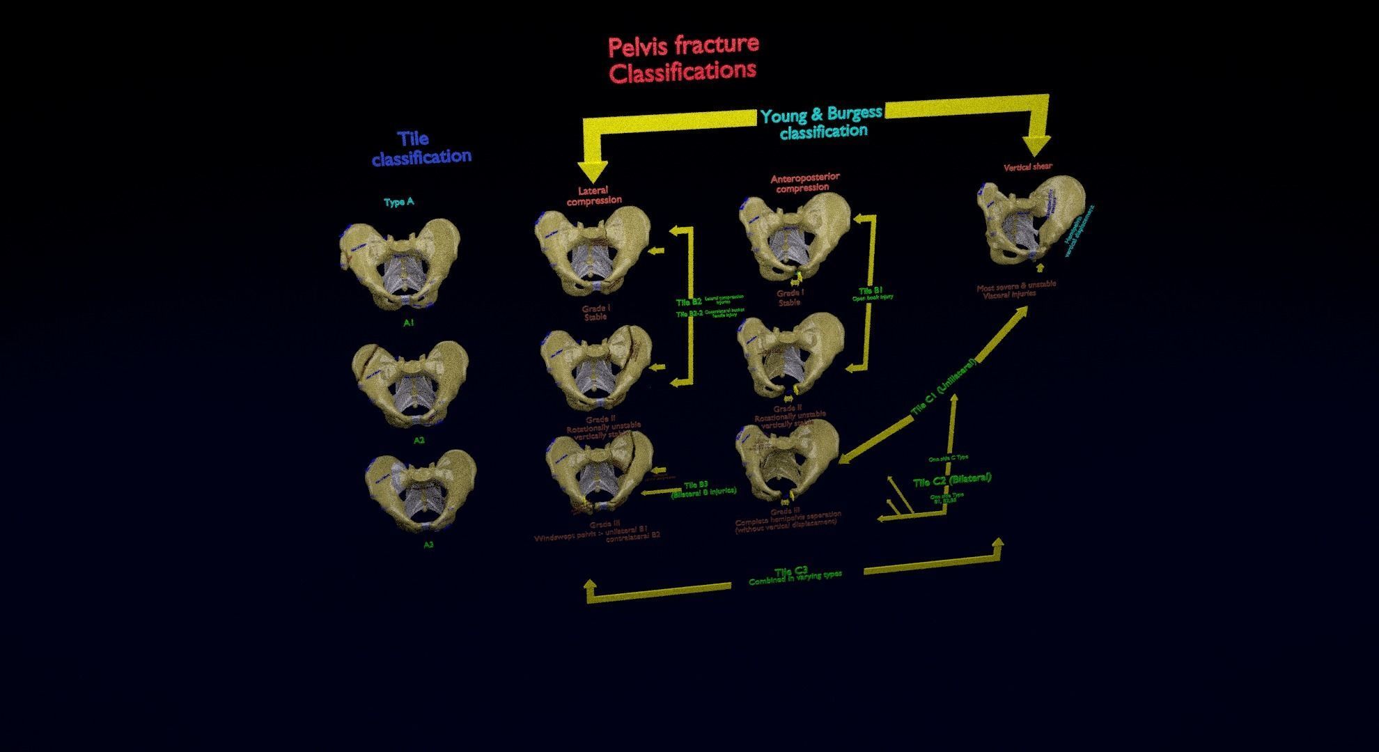Pelvis fracture classifications 3D model_18