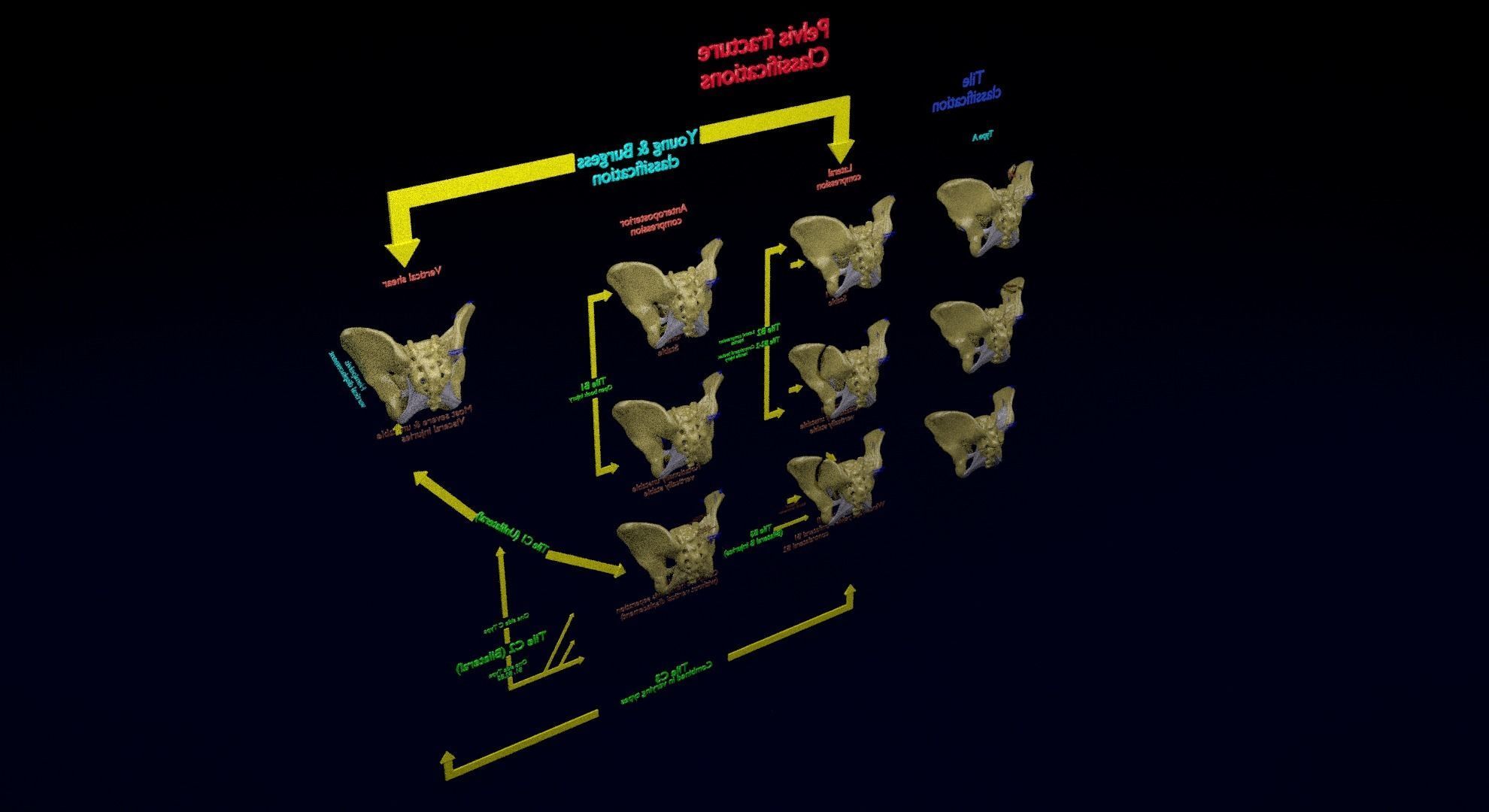 Pelvis fracture classifications 3D model_29