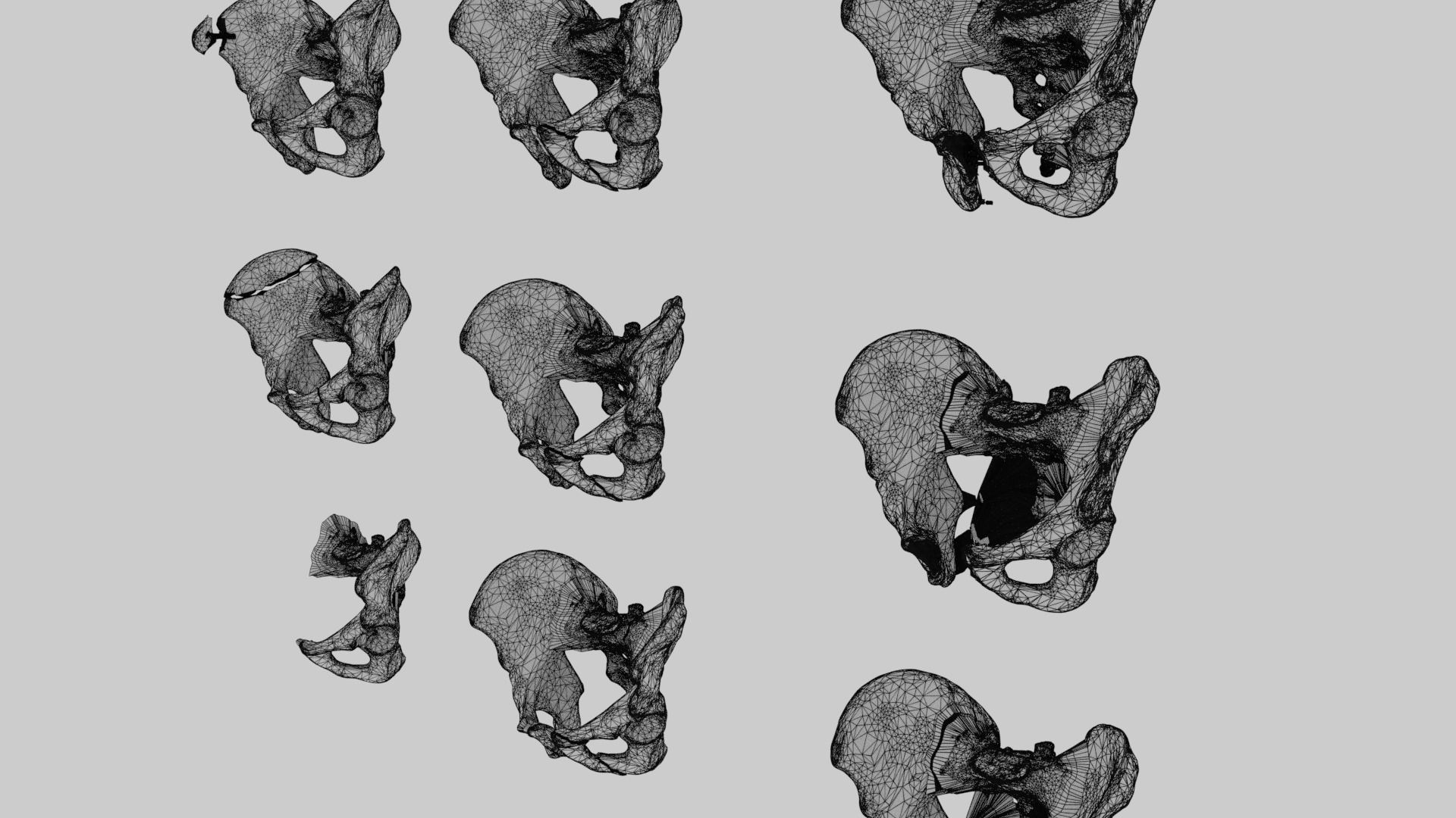 Pelvis fracture classifications 3D model_6
