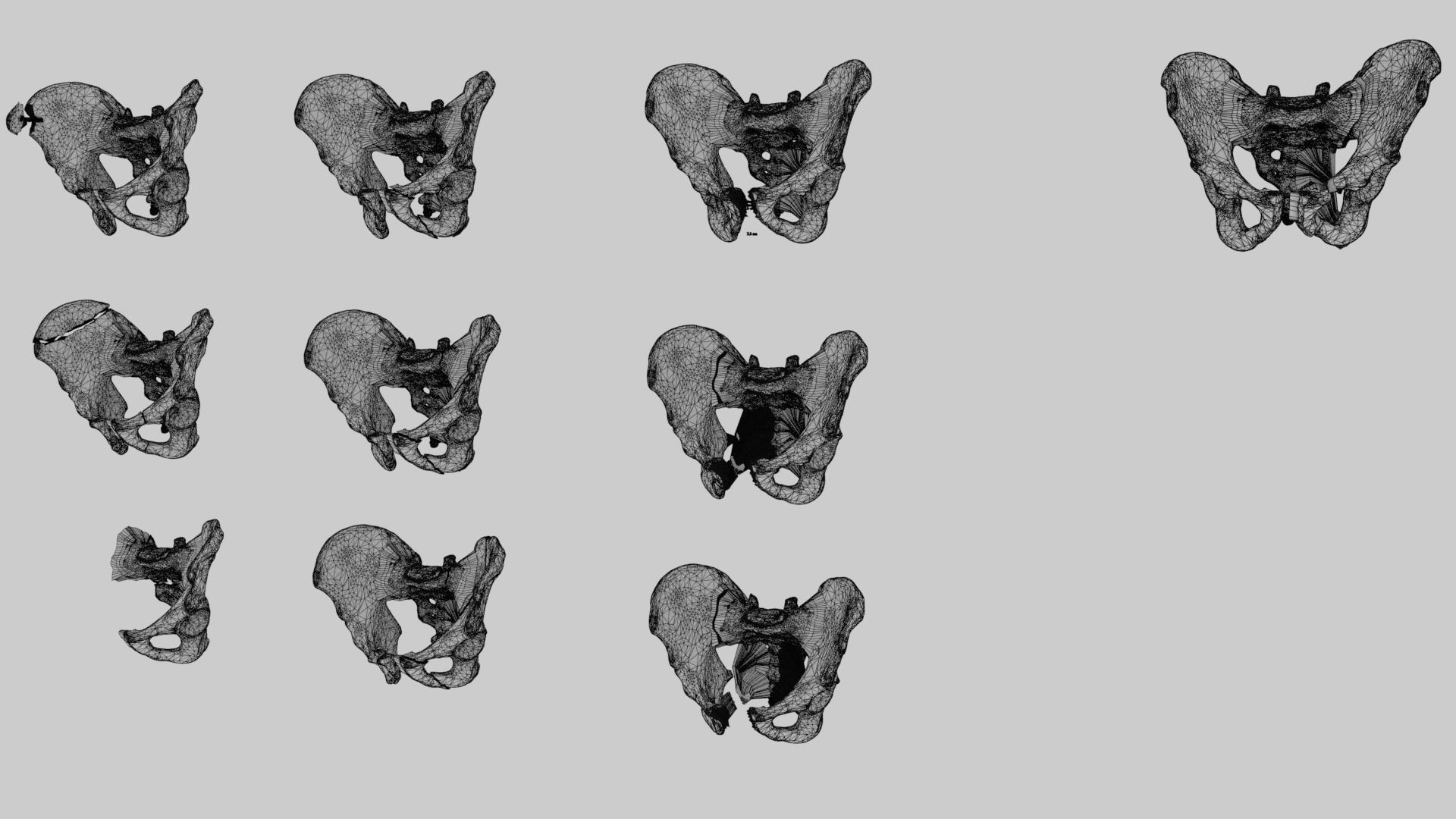 Pelvis fracture classifications 3D model_5