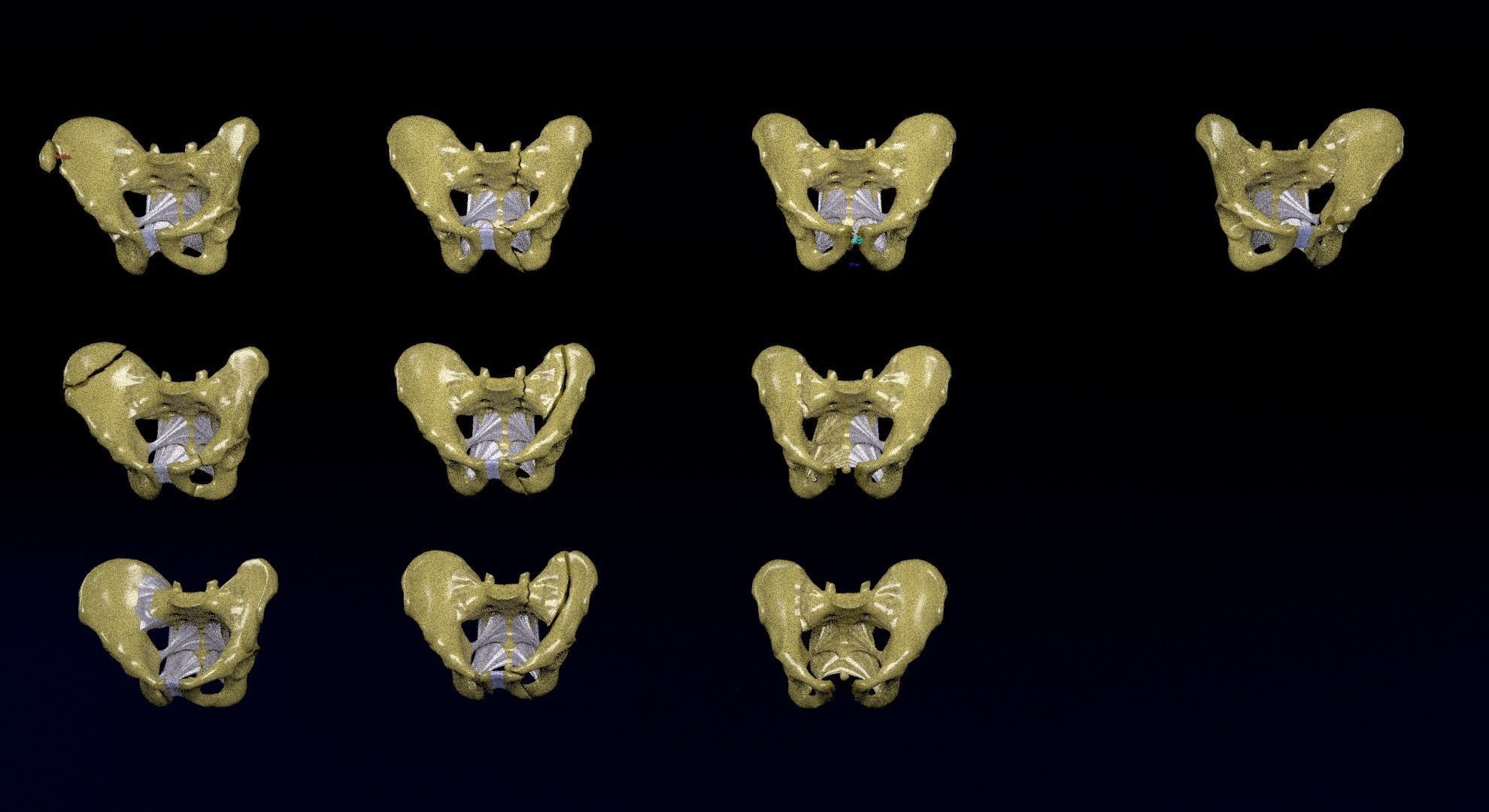 Pelvis fracture classifications 3D model_3