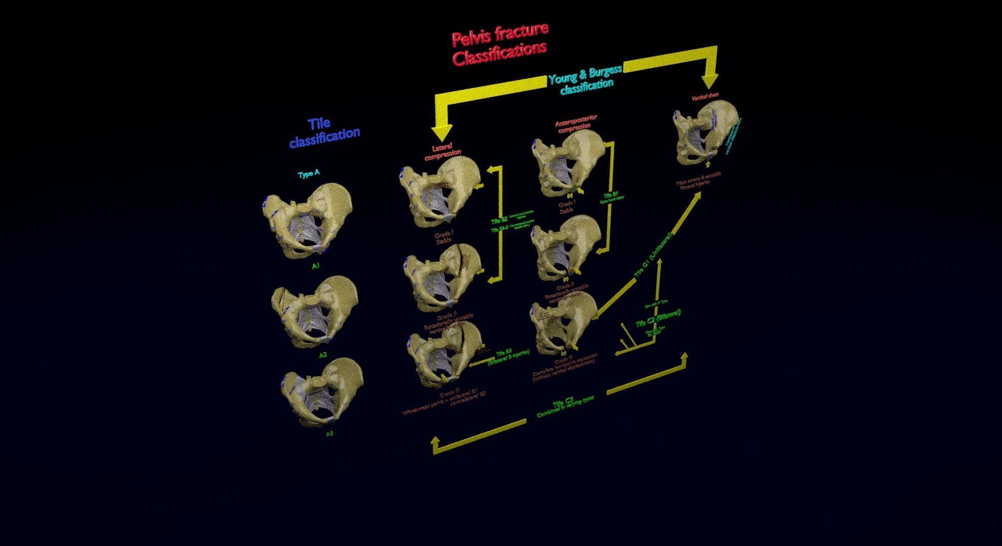 Pelvis fracture classifications 3D model_45