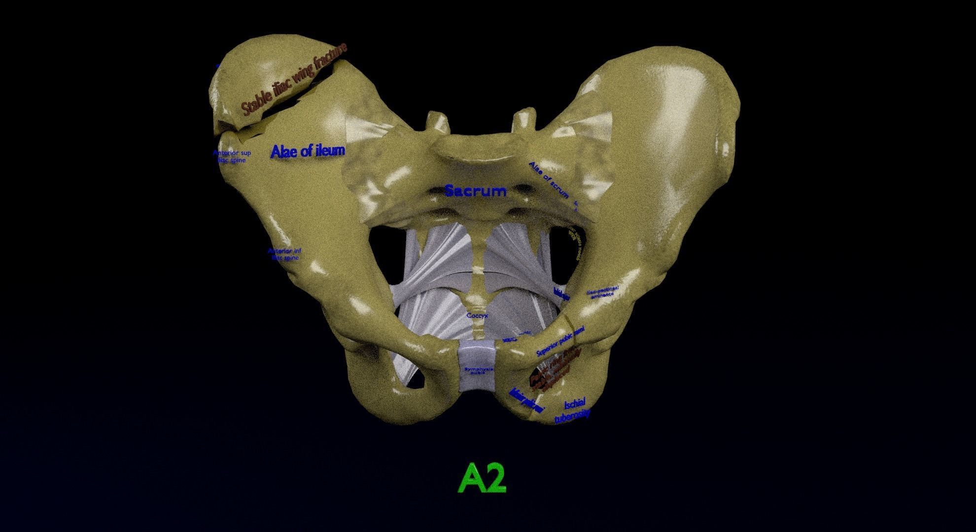 Pelvis fracture classifications 3D model_8