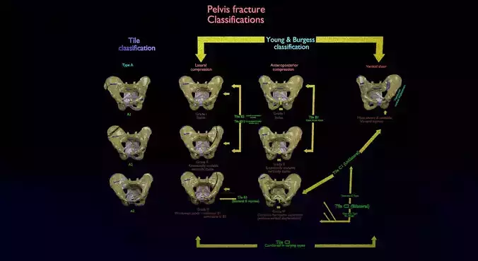 Pelvis fracture classifications