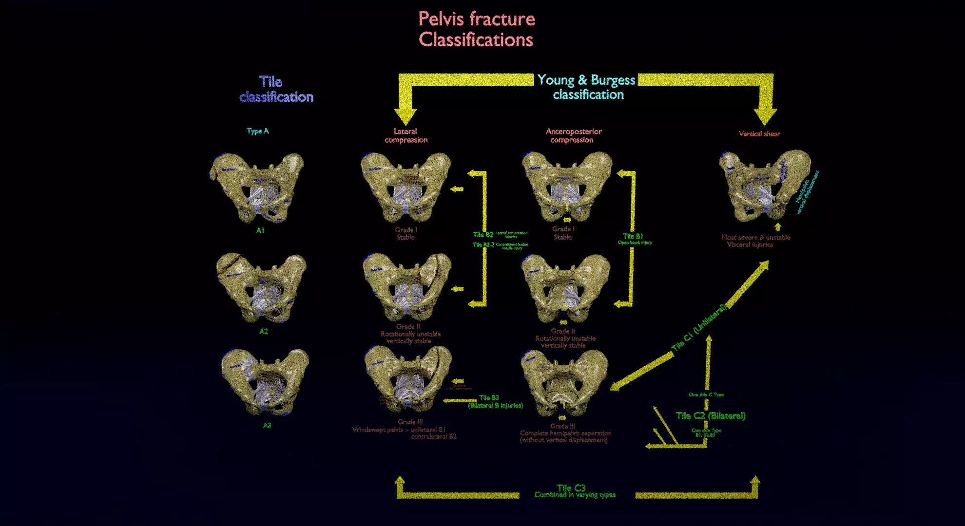Pelvis fracture classifications 3D model_0