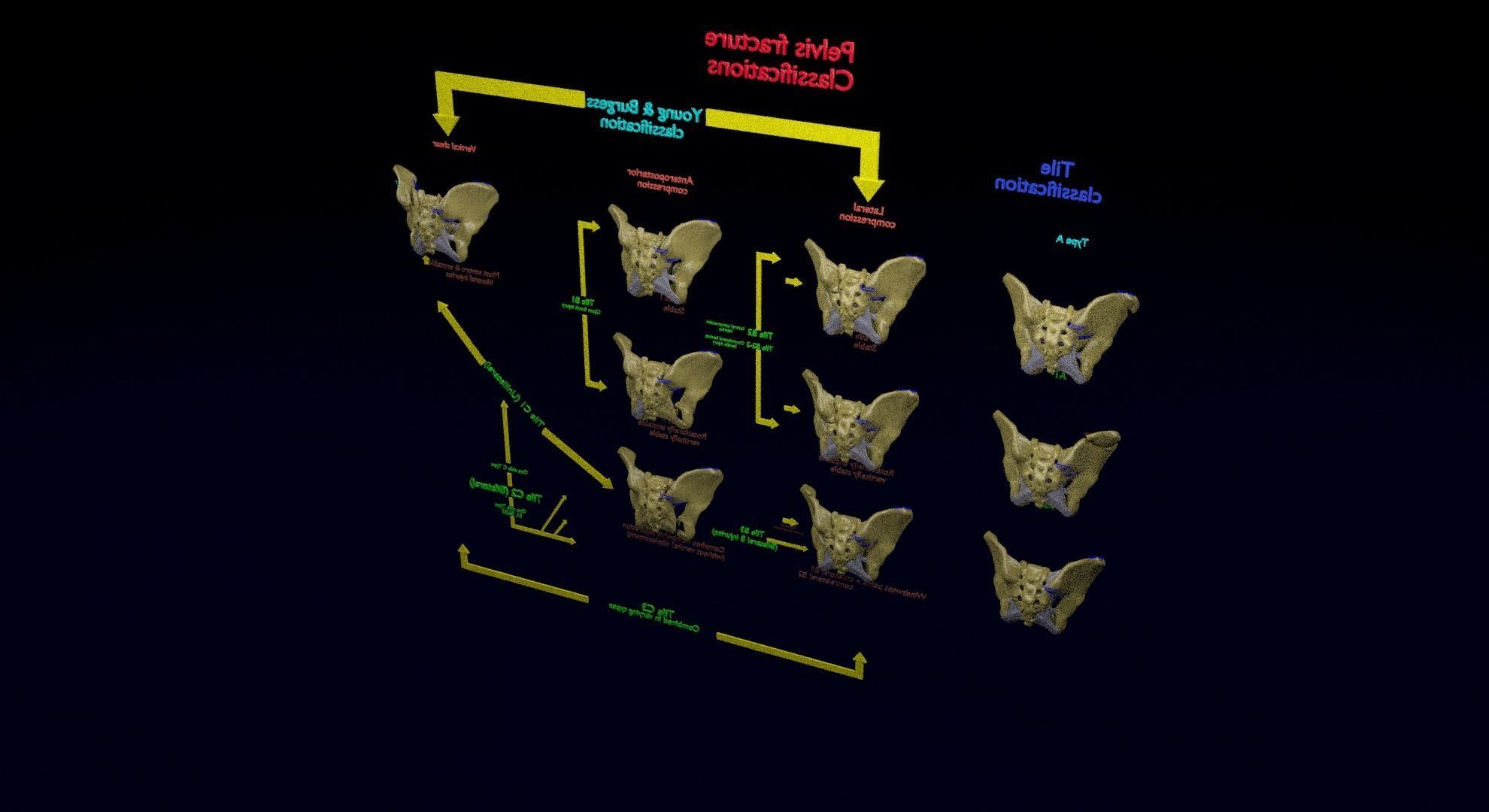 Pelvis fracture classifications 3D model_37
