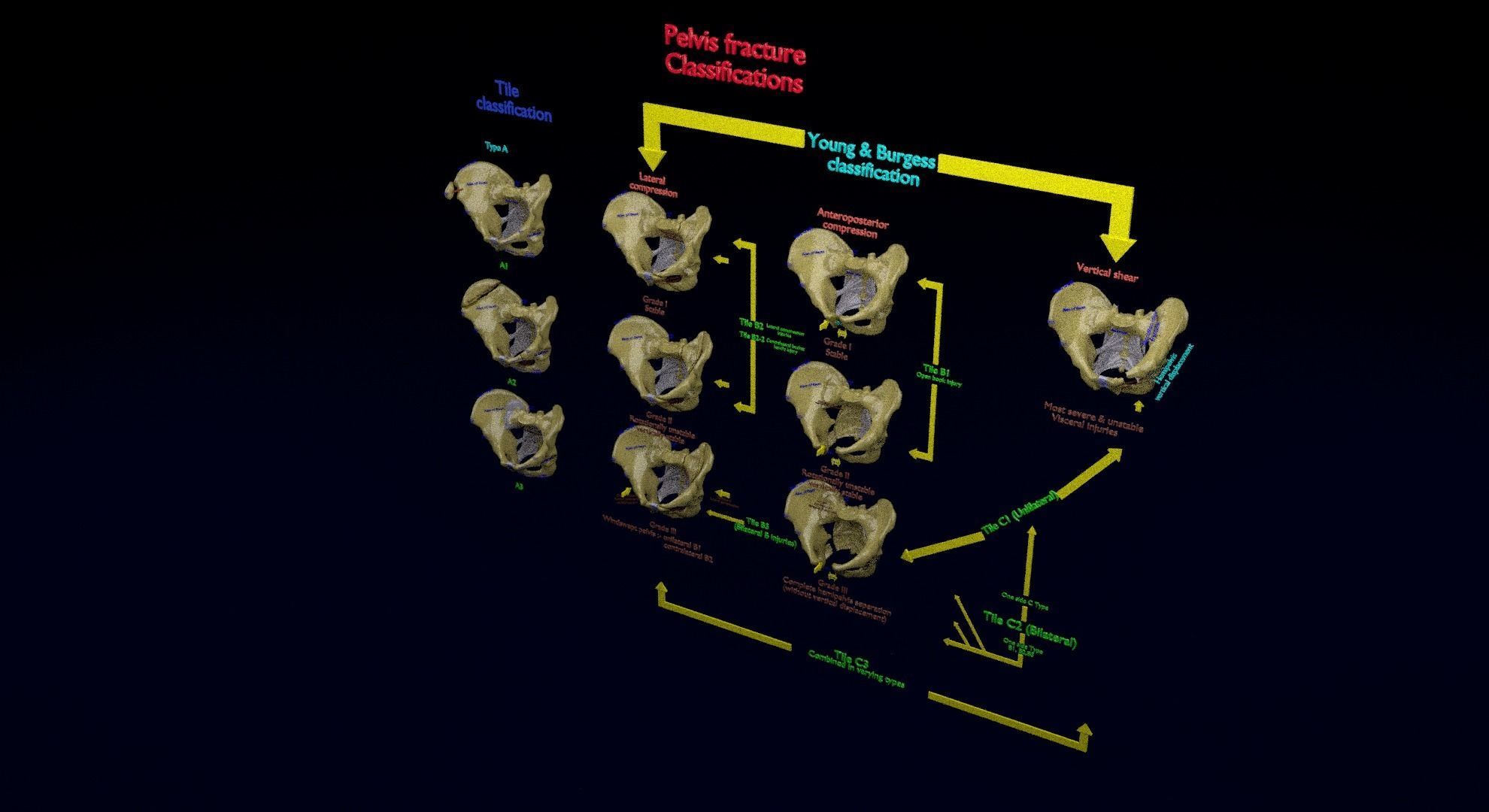 Pelvis fracture classifications 3D model_22