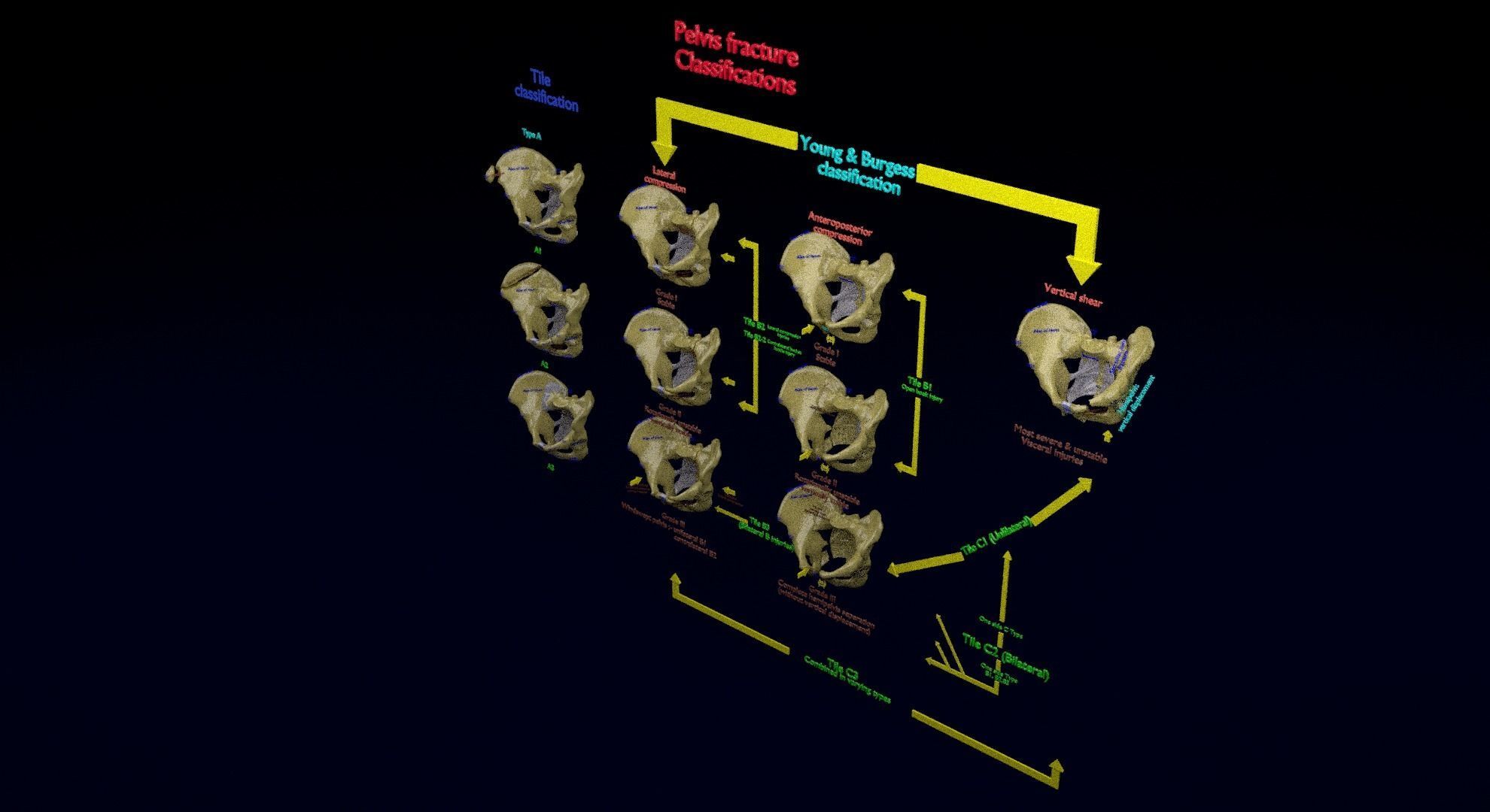 Pelvis fracture classifications 3D model_16
