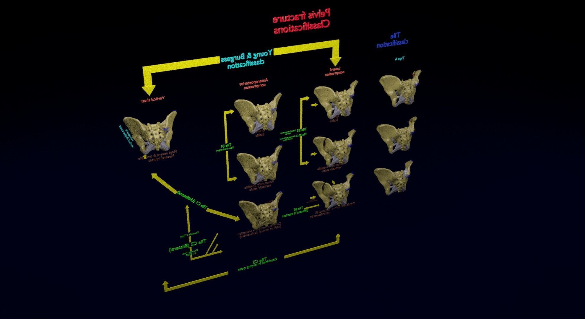 Pelvis fracture classifications 3D model_42