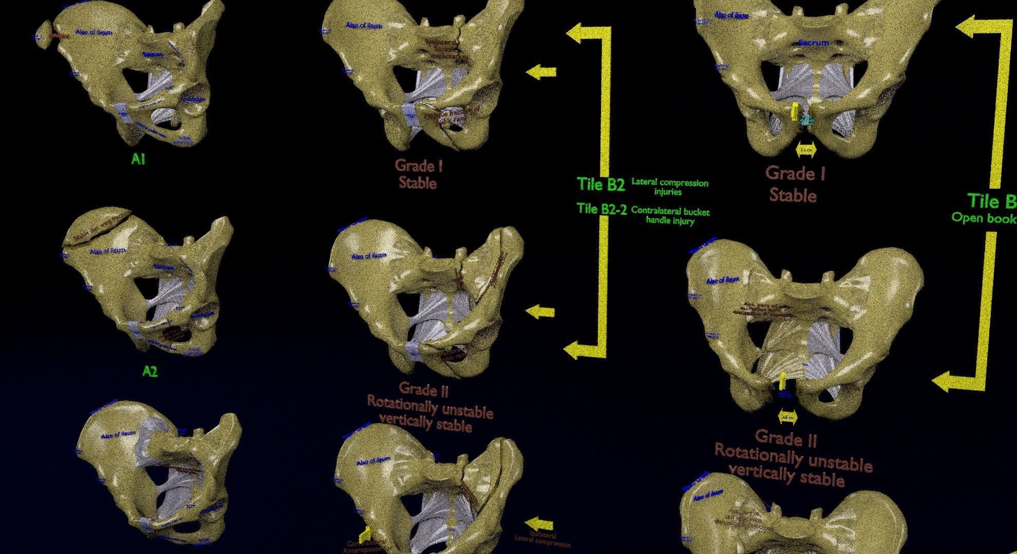 Pelvis fracture classifications 3D model_12