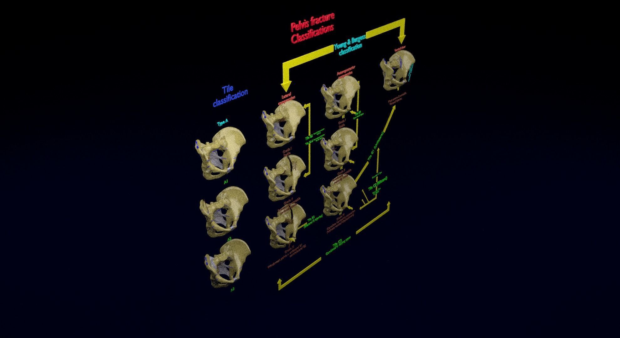 Pelvis fracture classifications 3D model_36