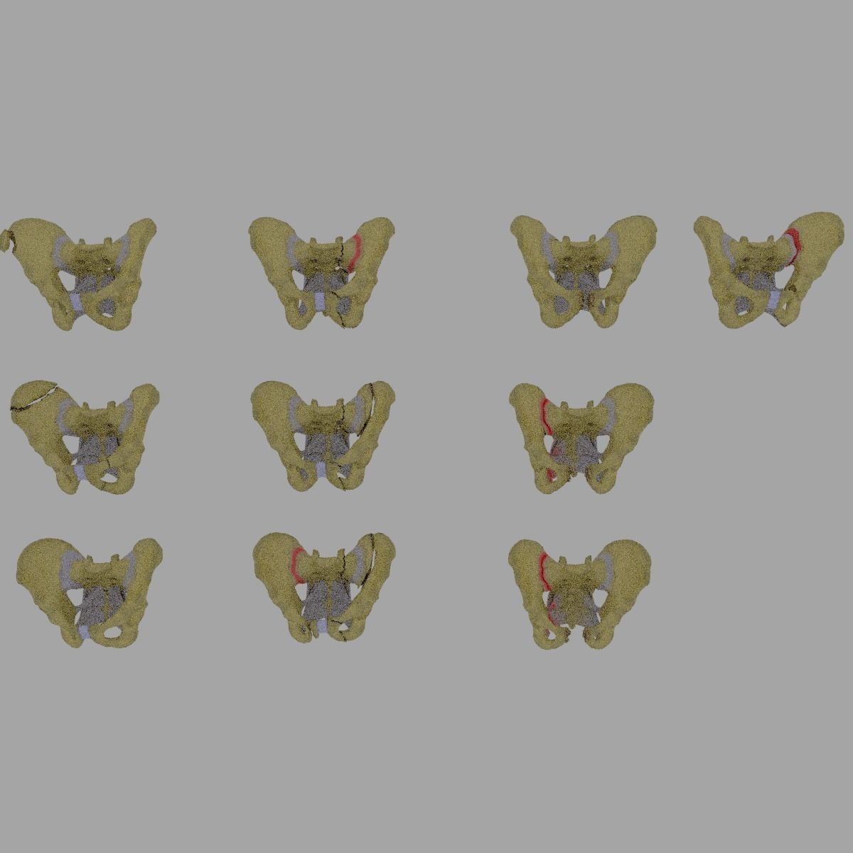 Pelvis fracture classifications 3D model_2