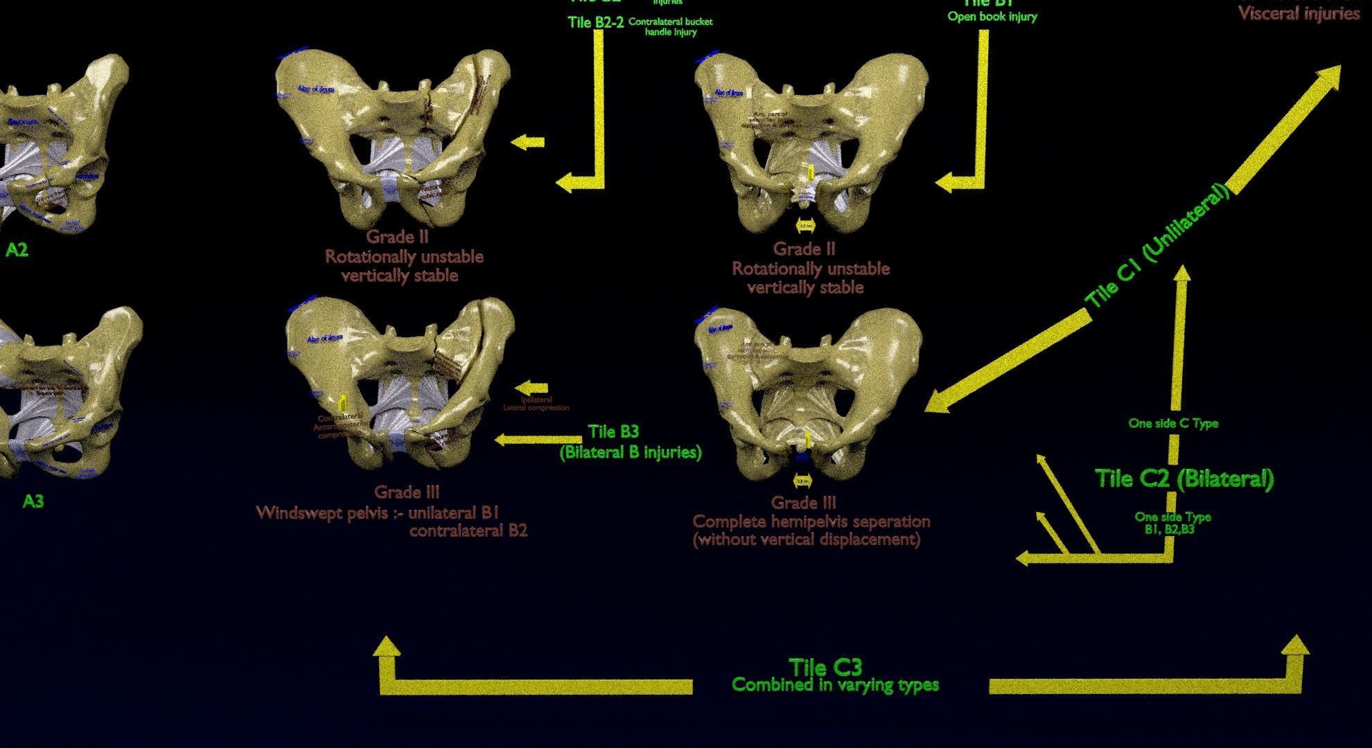 Pelvis fracture classifications 3D model_10
