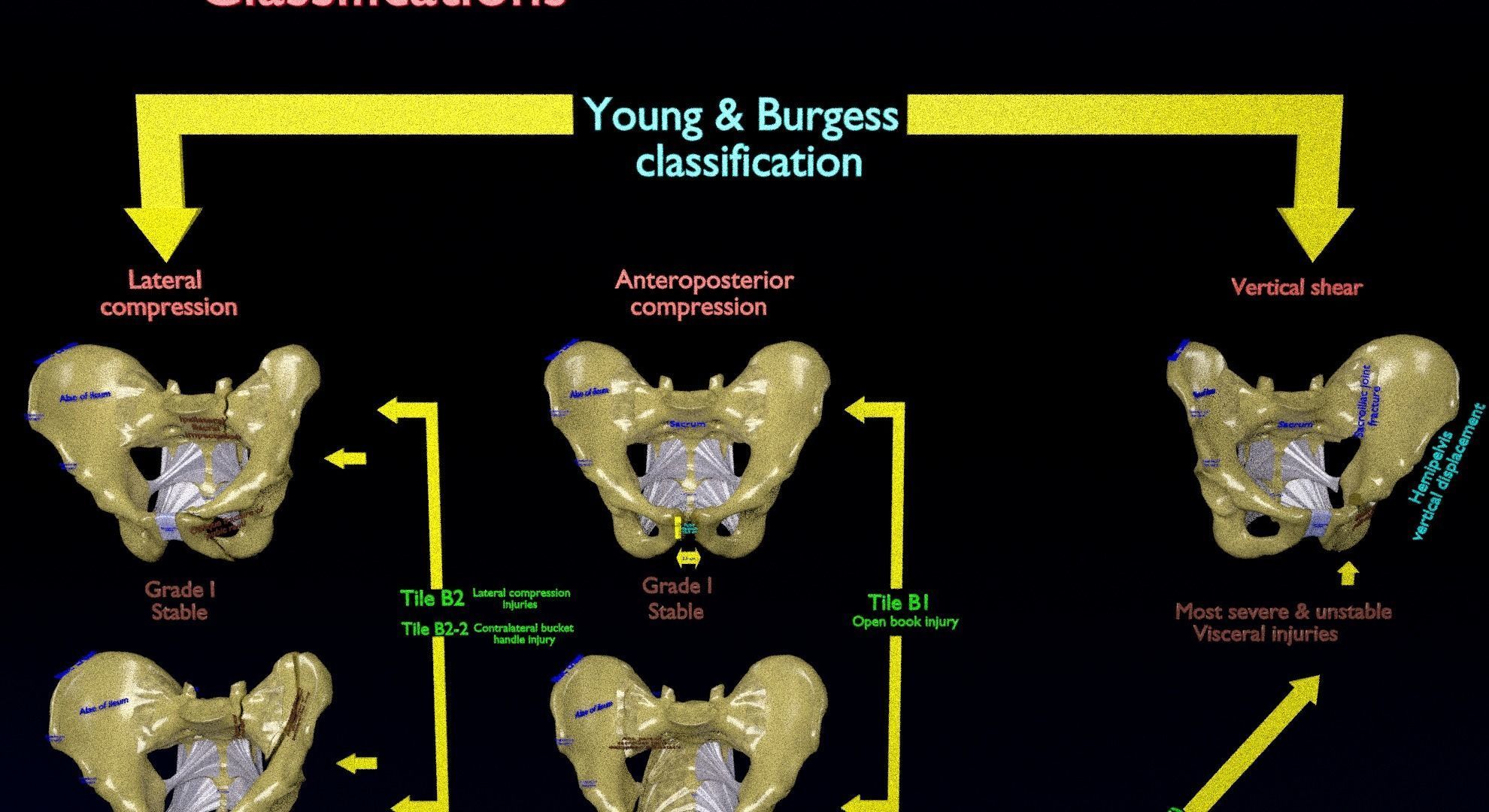 Pelvis fracture classifications 3D model_11