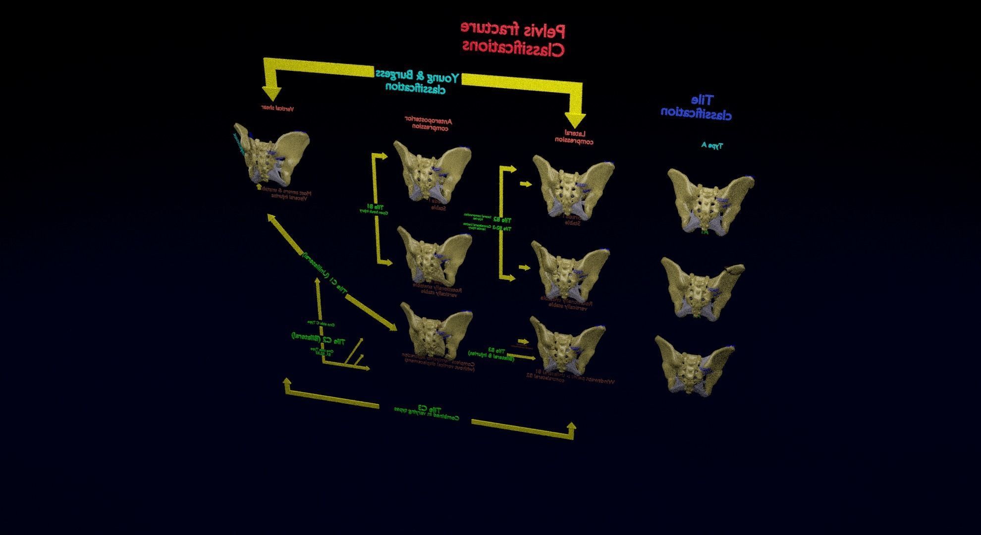 Pelvis fracture classifications 3D model_38
