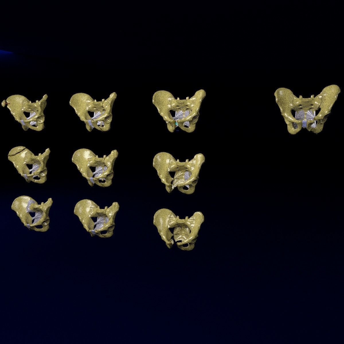 Pelvis fracture classifications 3D model_4