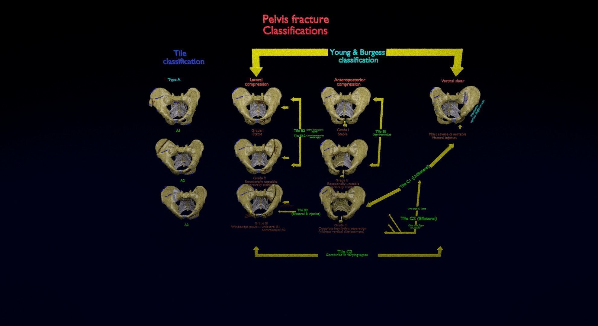 Pelvis fracture classifications 3D model_33