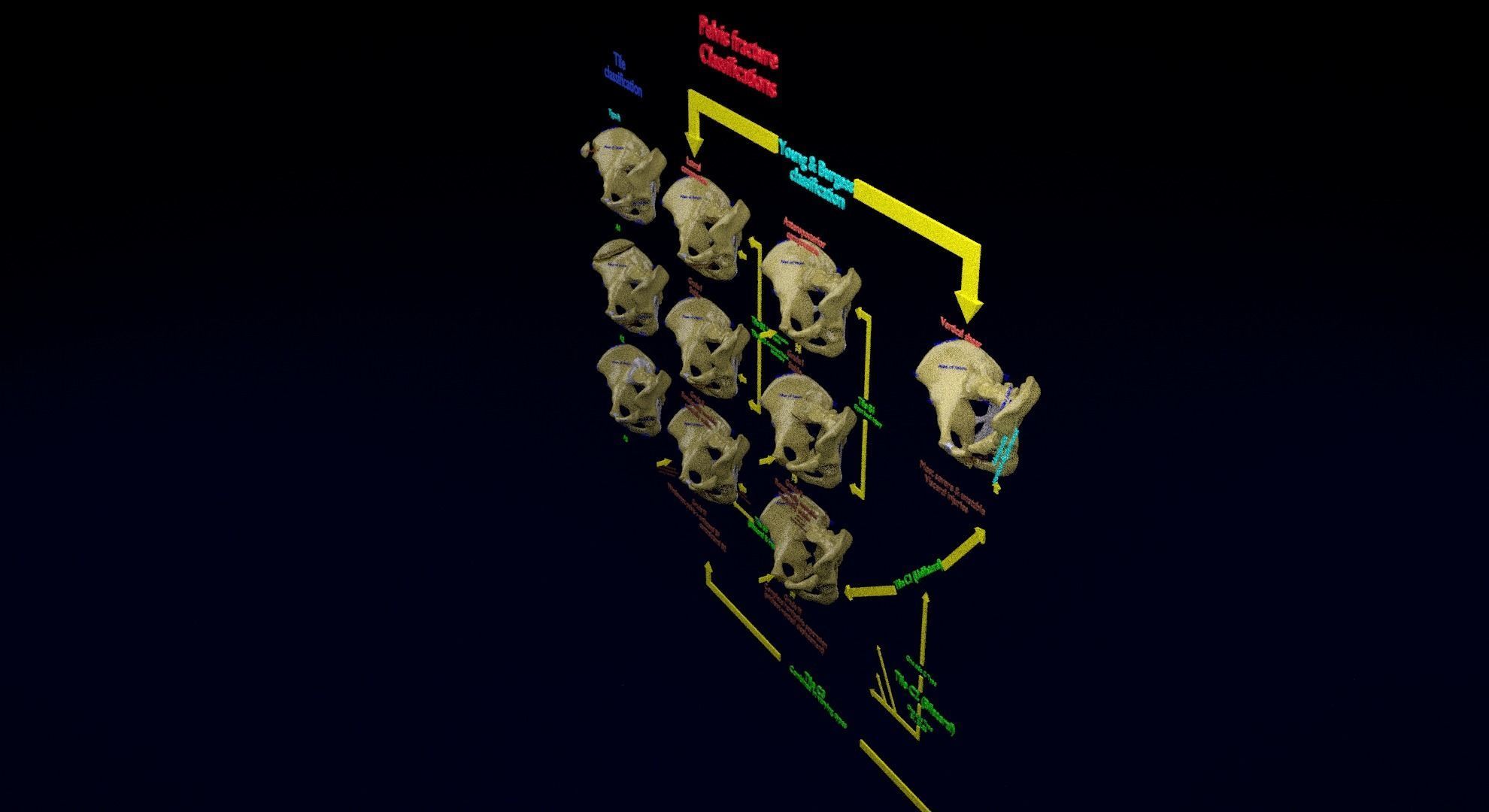 Pelvis fracture classifications 3D model_47