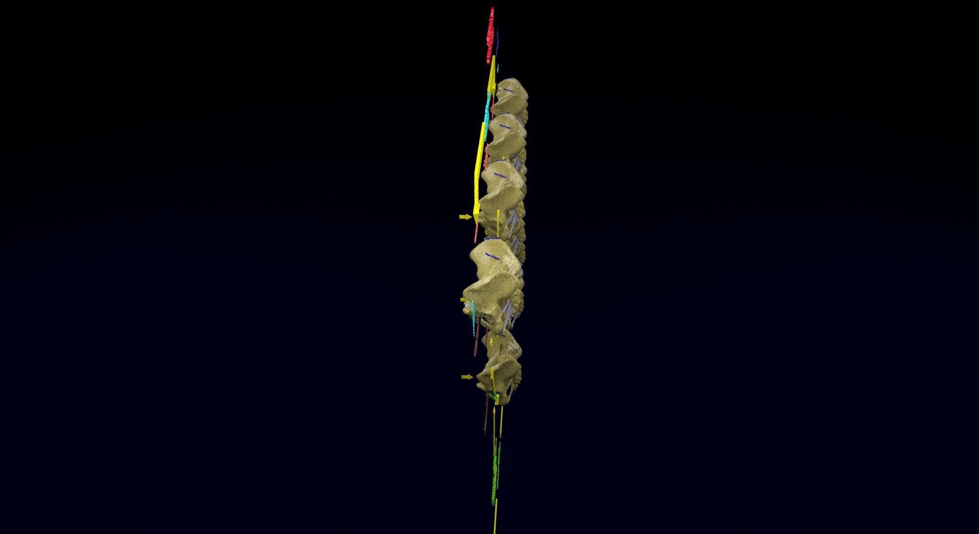 Pelvis fracture classifications 3D model_15