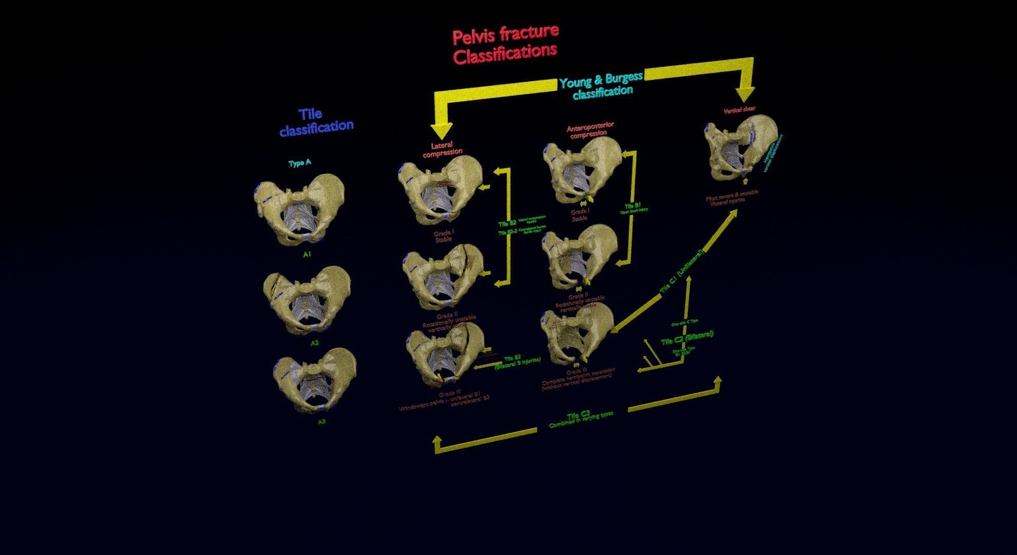 Pelvis fracture classifications 3D model_44