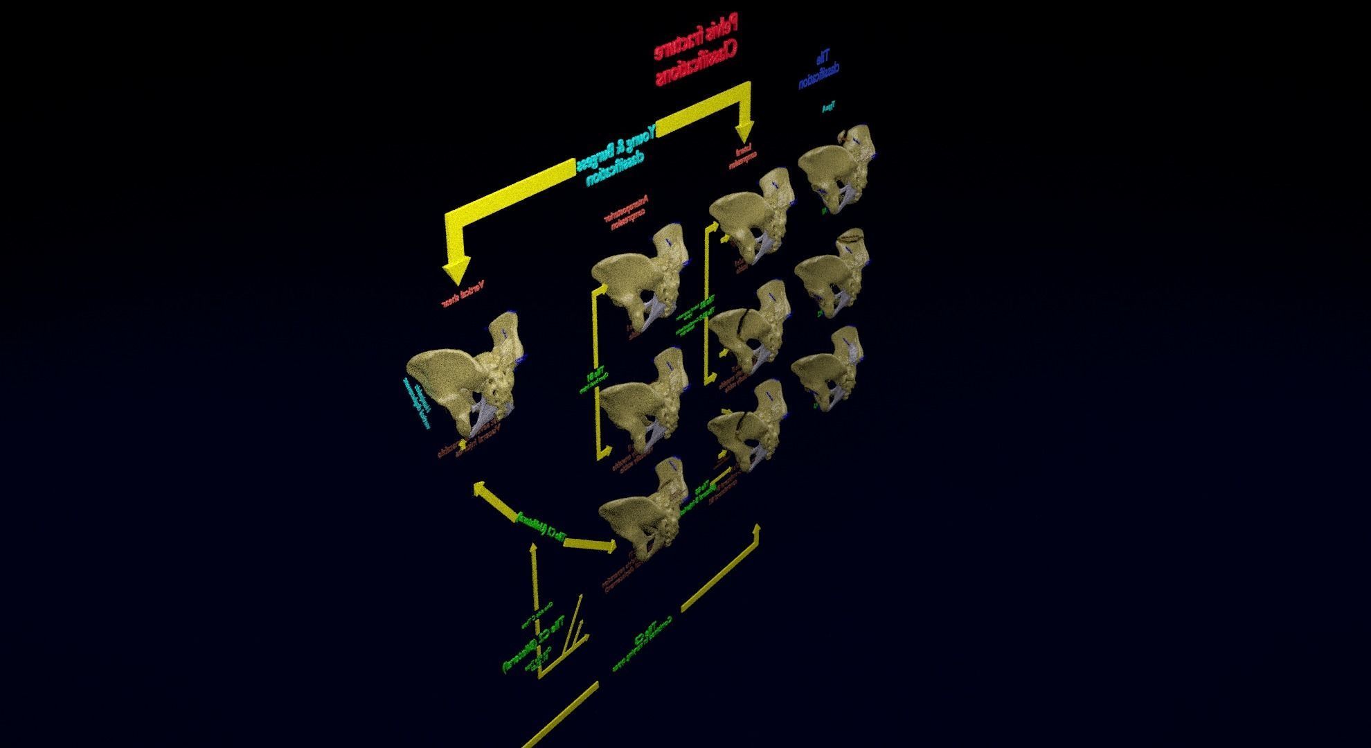 Pelvis fracture classifications 3D model_41