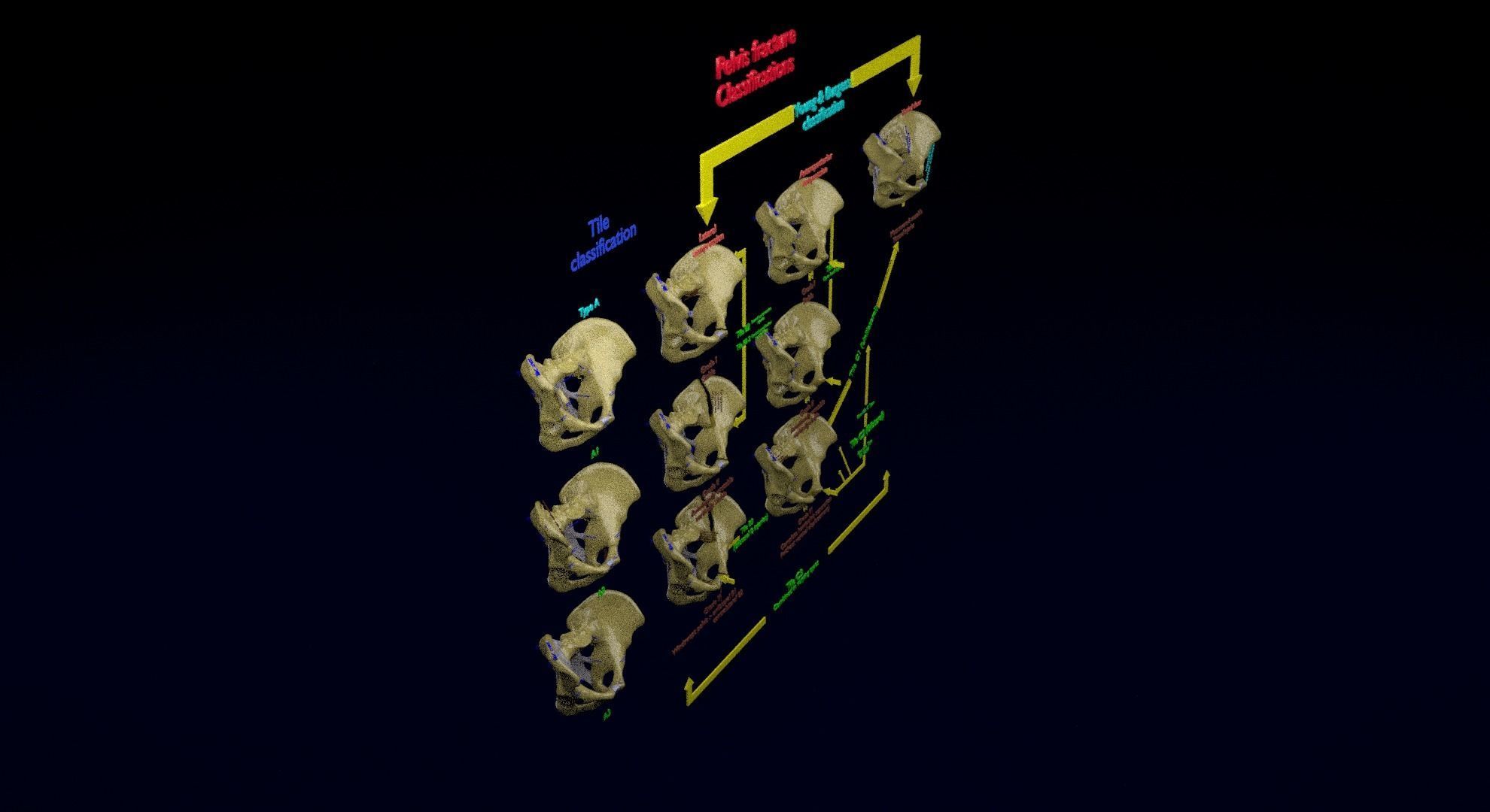 Pelvis fracture classifications 3D model_25