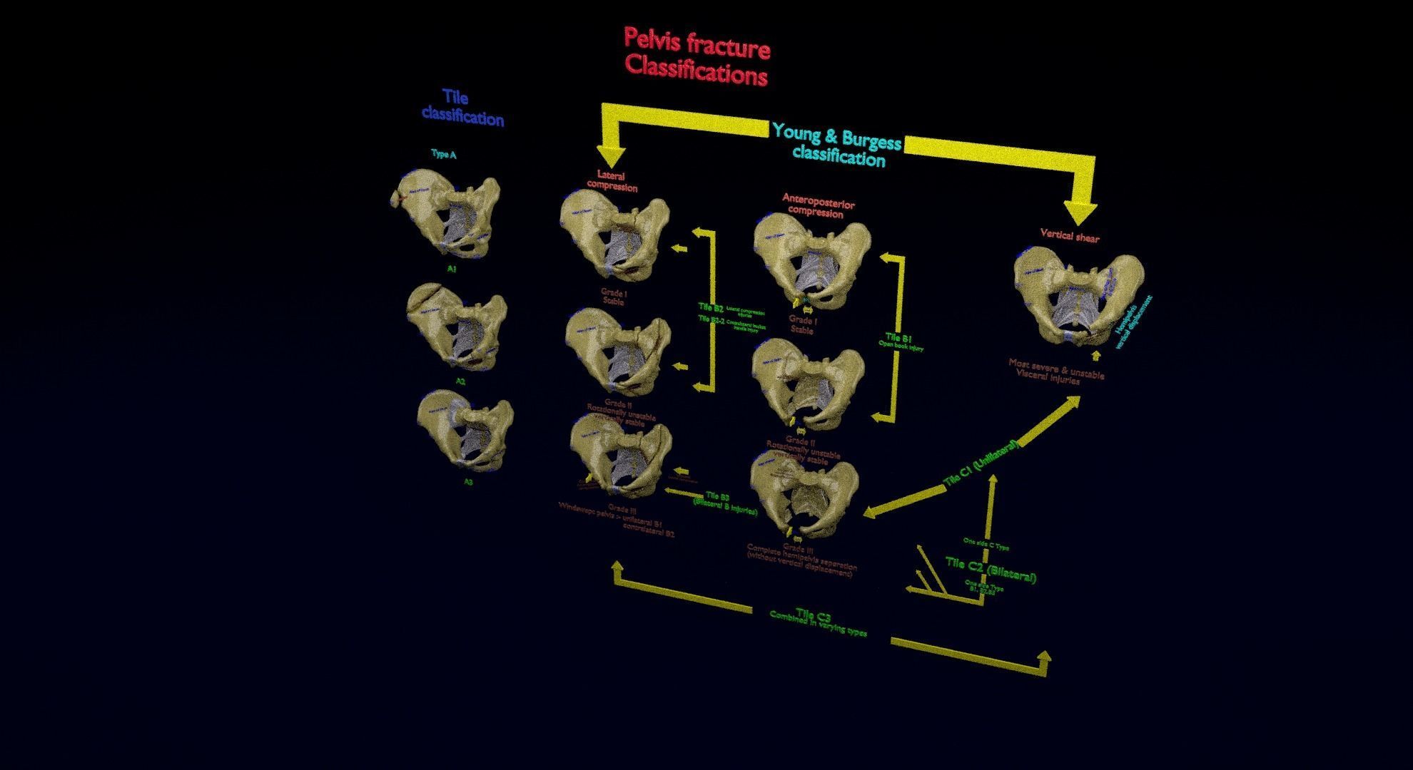 Pelvis fracture classifications 3D model_21