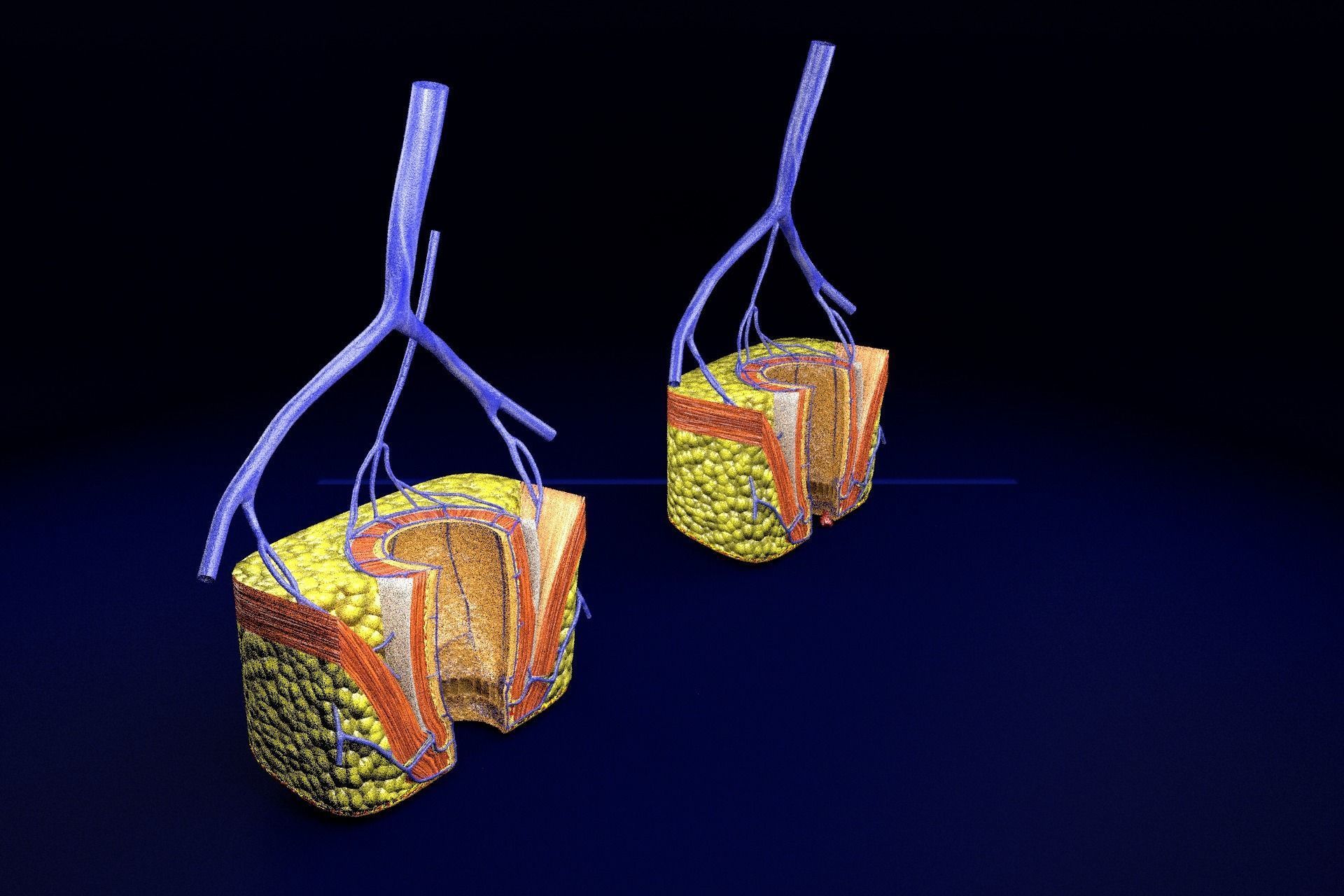 hemorrhoids piles 3D model_77