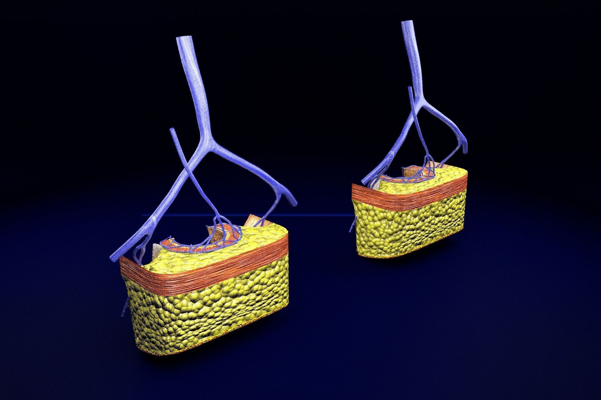 hemorrhoids piles 3D model_74