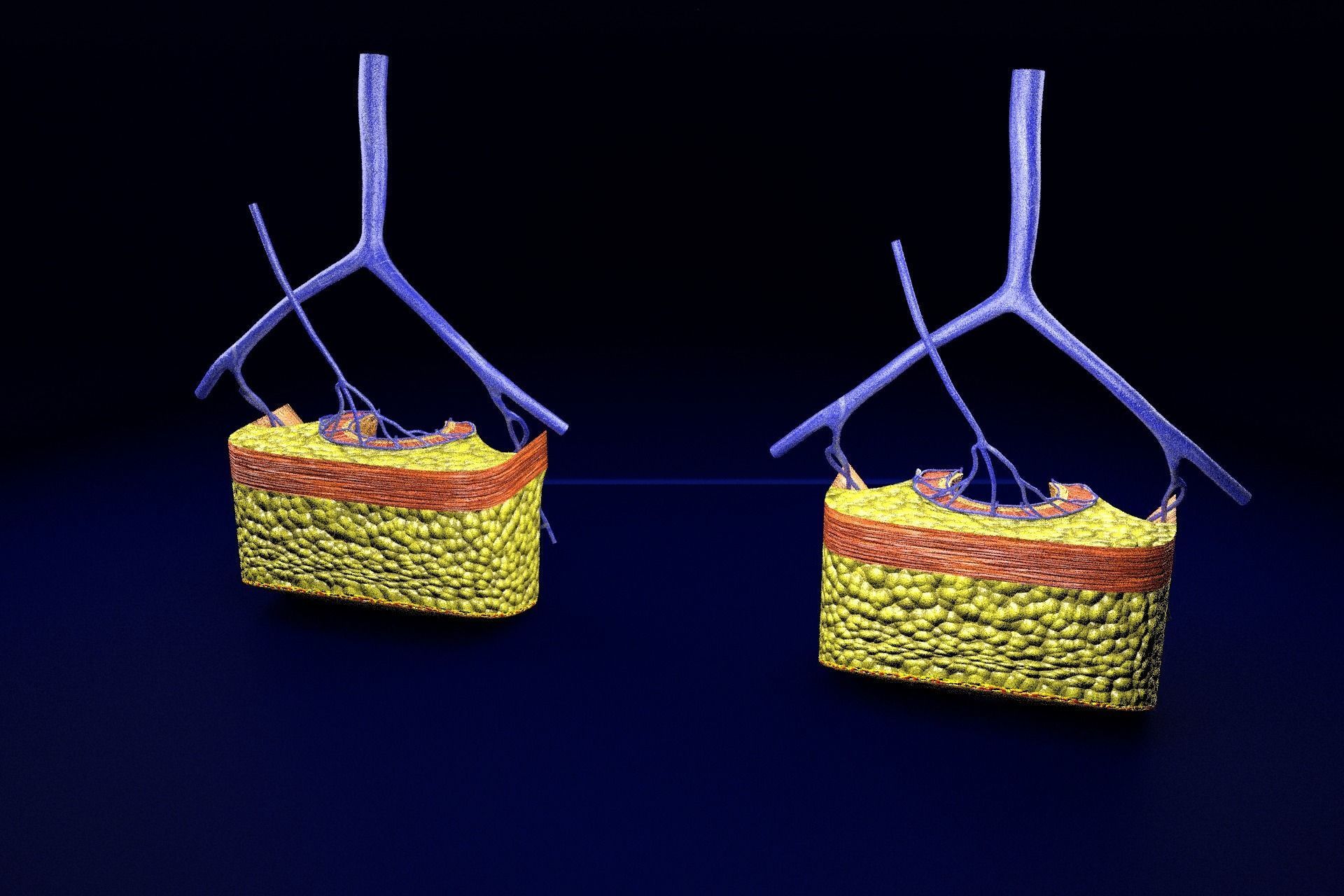 hemorrhoids piles 3D model_23