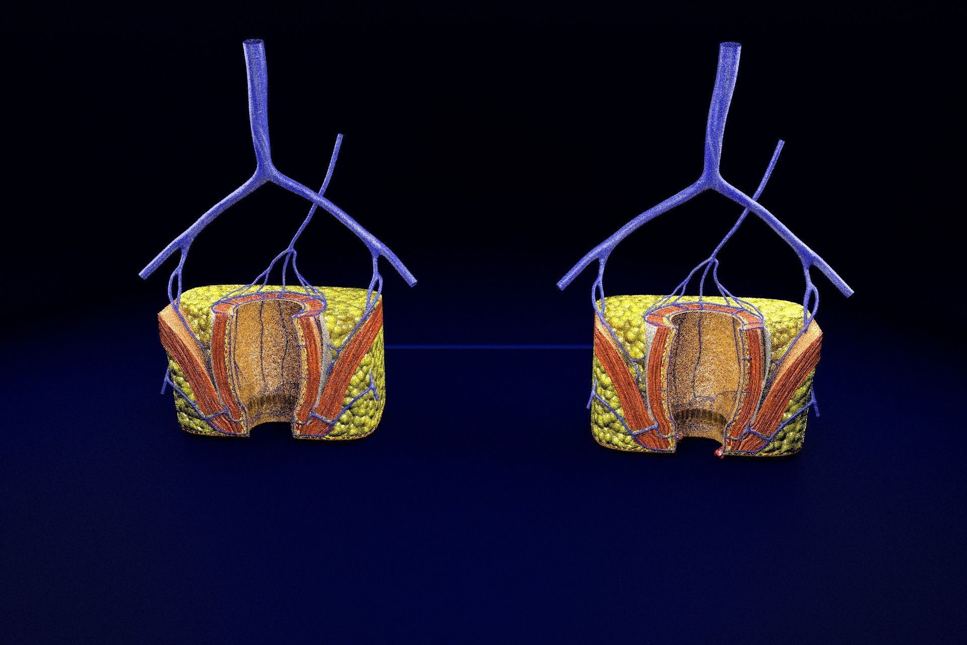 hemorrhoids piles 3D model_87