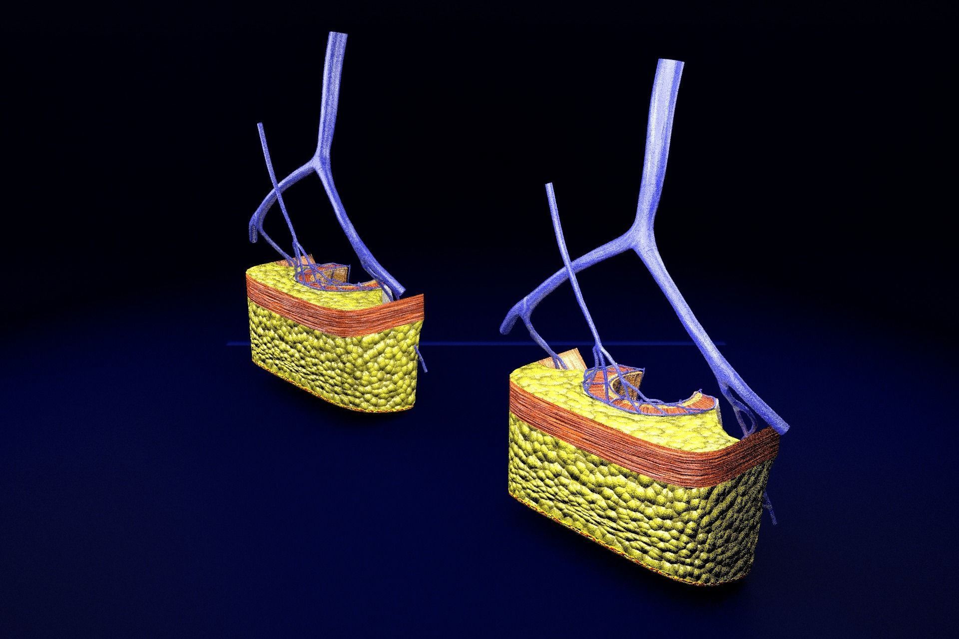 hemorrhoids piles 3D model_28