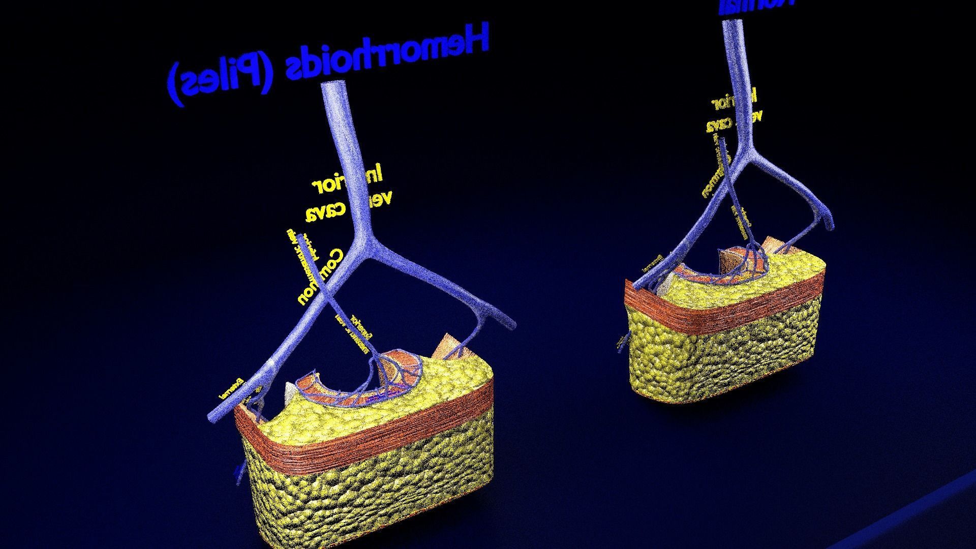 hemorrhoids piles 3D model_12