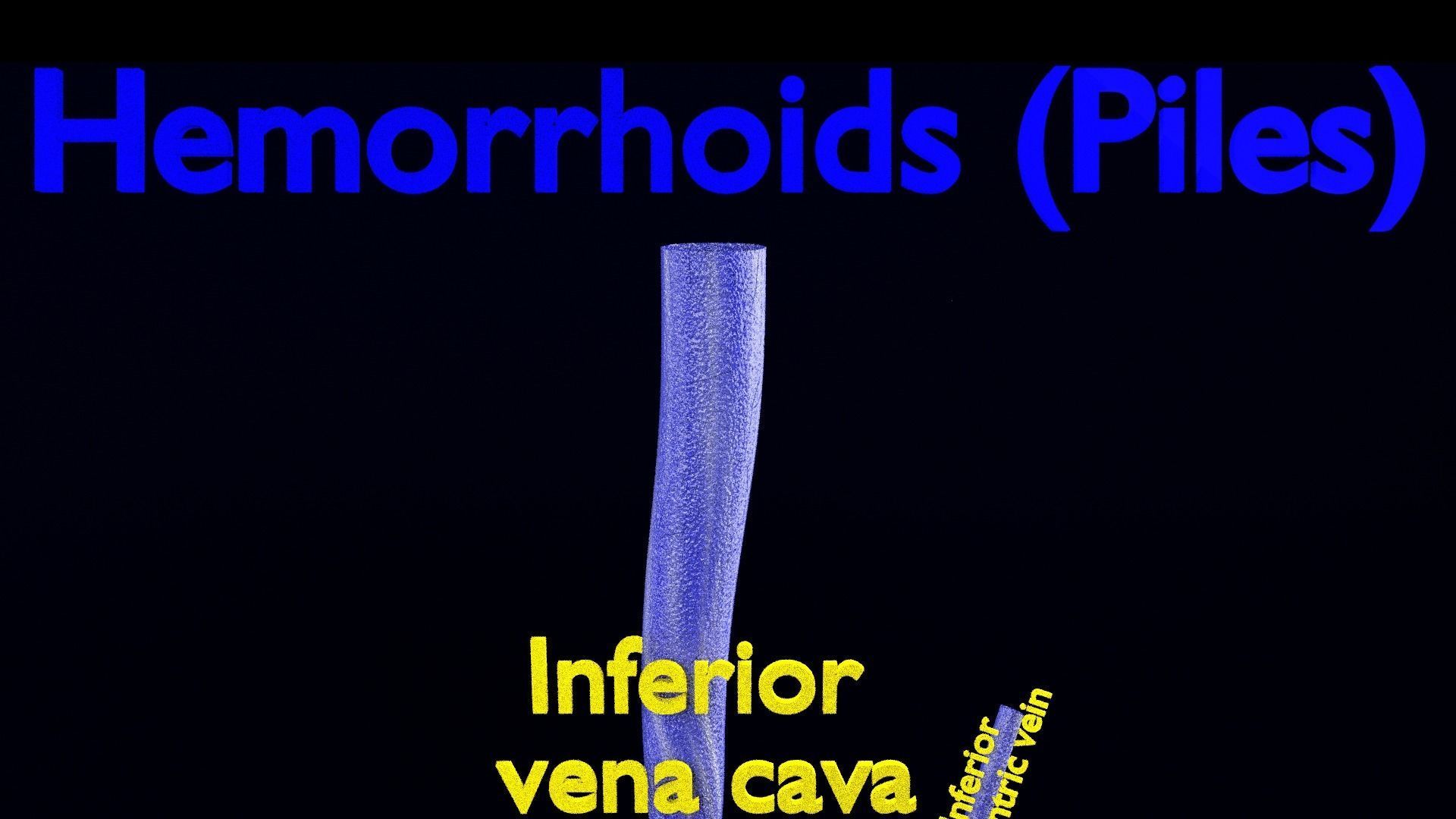 hemorrhoids piles 3D model_9